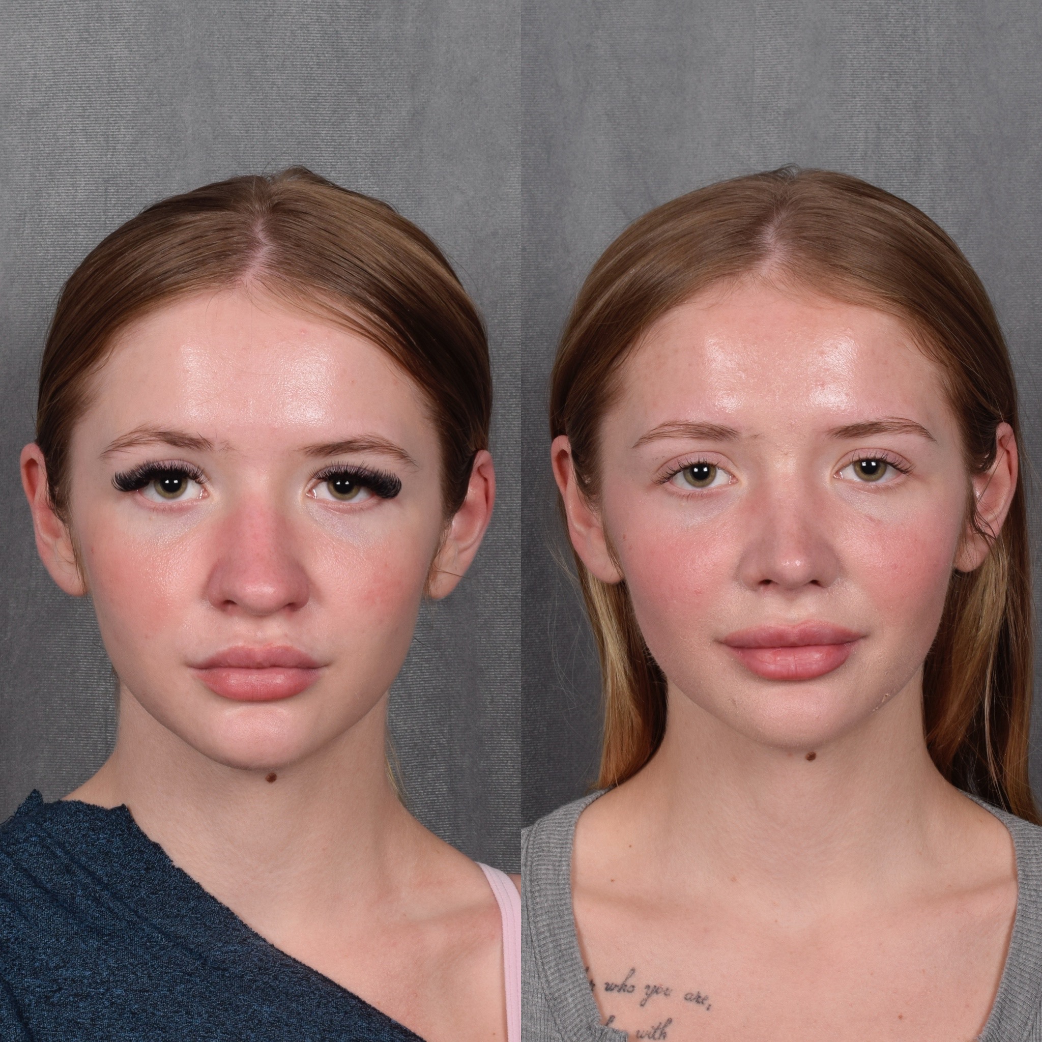Rhinoplasty Before & After Gallery - Patient 105222 - Image 4