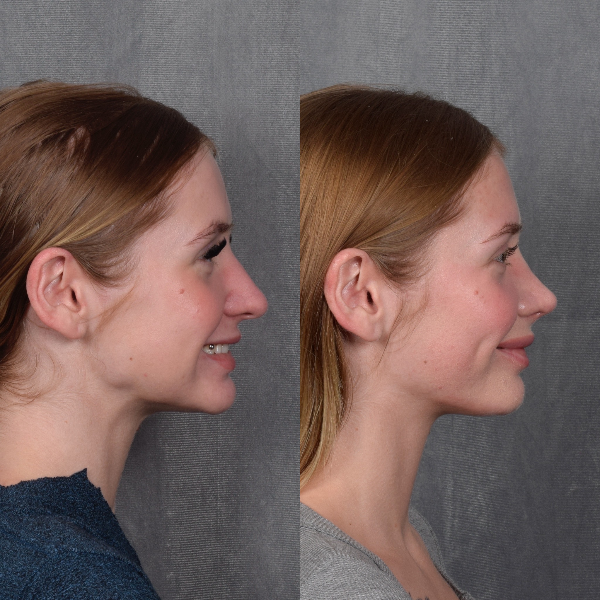 Rhinoplasty Before & After Gallery - Patient 105222 - Image 7