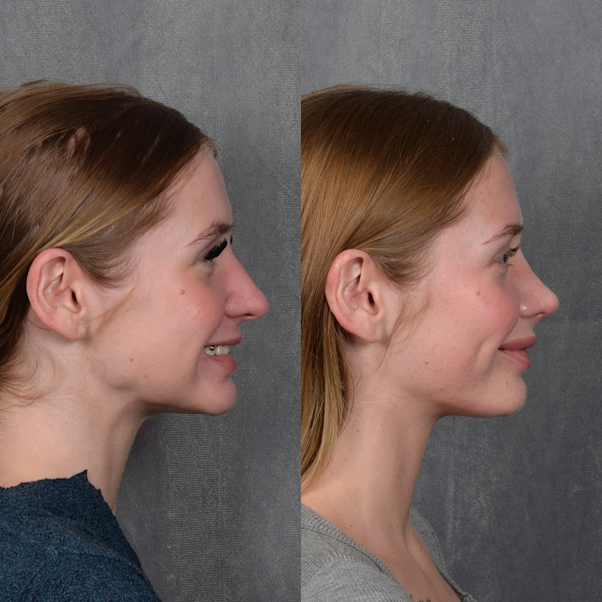 Rhinoplasty Before & After Gallery - Patient 105222 - Image 7