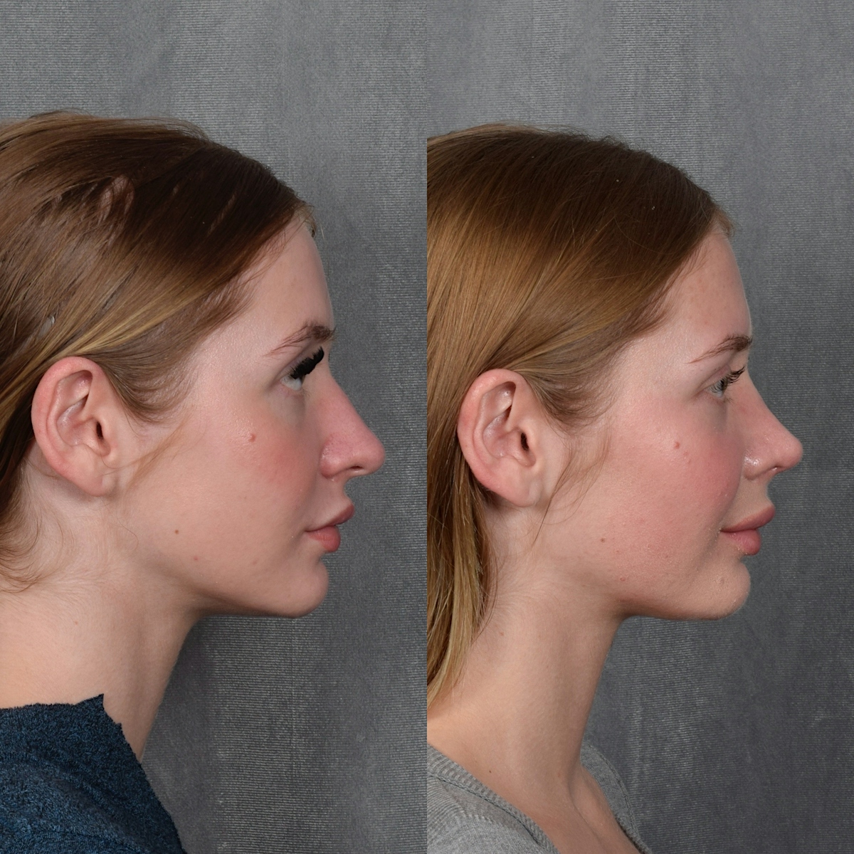 Rhinoplasty Before & After Gallery - Patient 105222 - Image 6