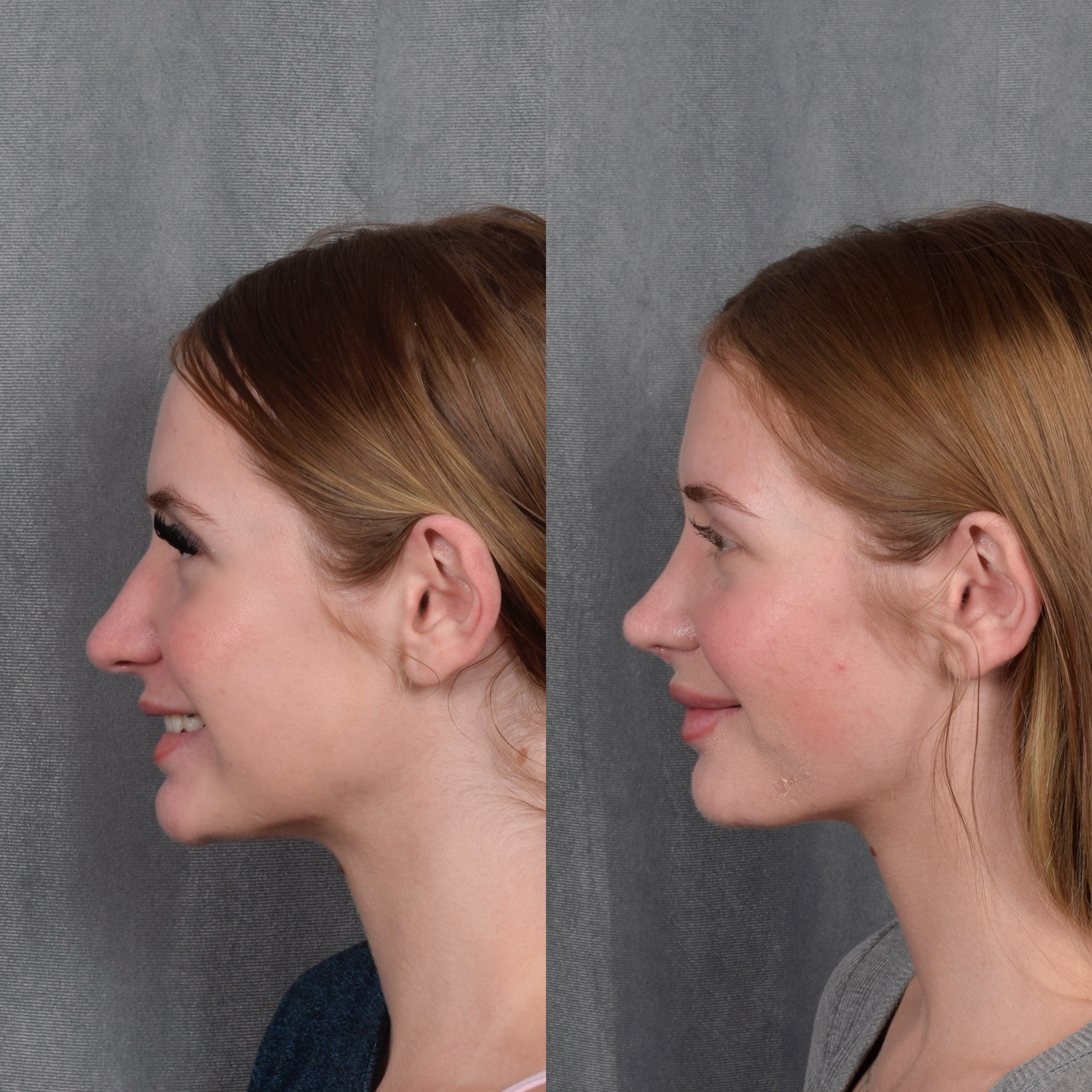 Rhinoplasty Before & After Gallery - Patient 105222 - Image 1