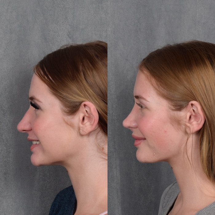 Rhinoplasty Before & After Gallery - Patient 105222 - Image 1