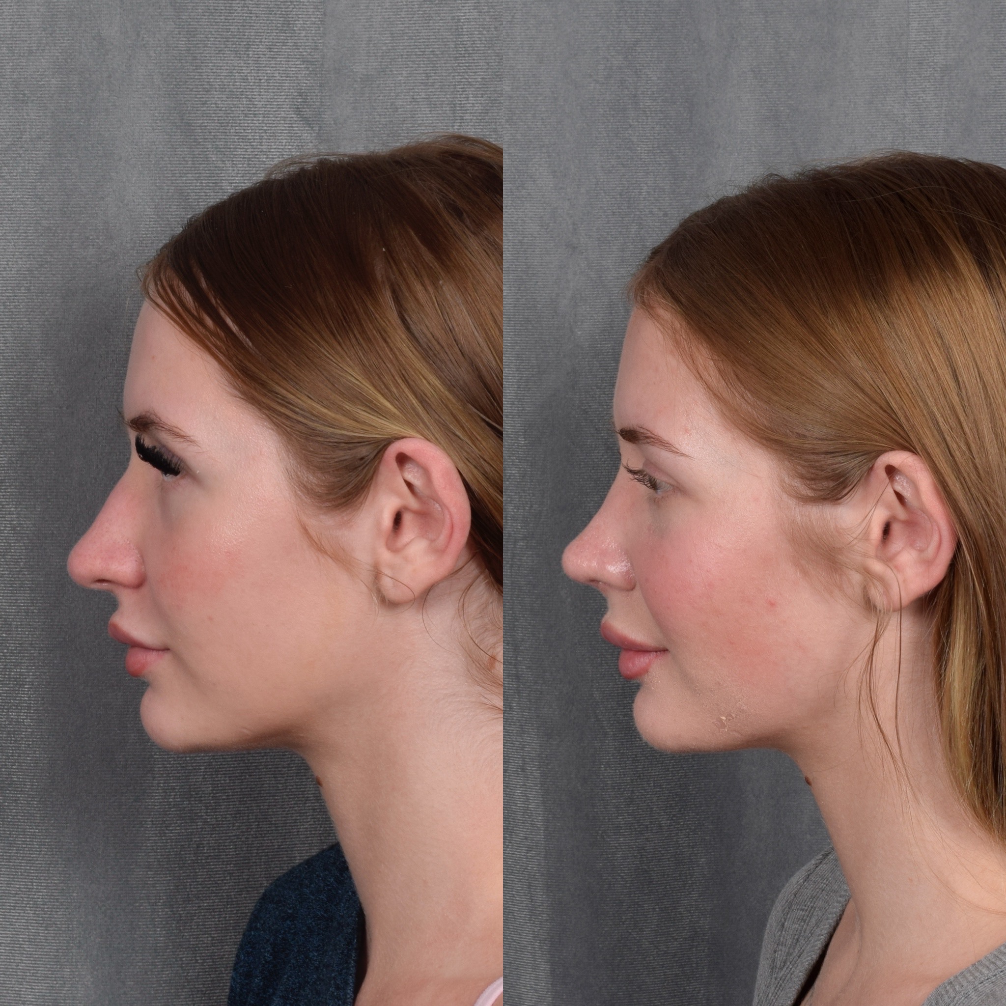 Rhinoplasty Before & After Gallery - Patient 105222 - Image 2