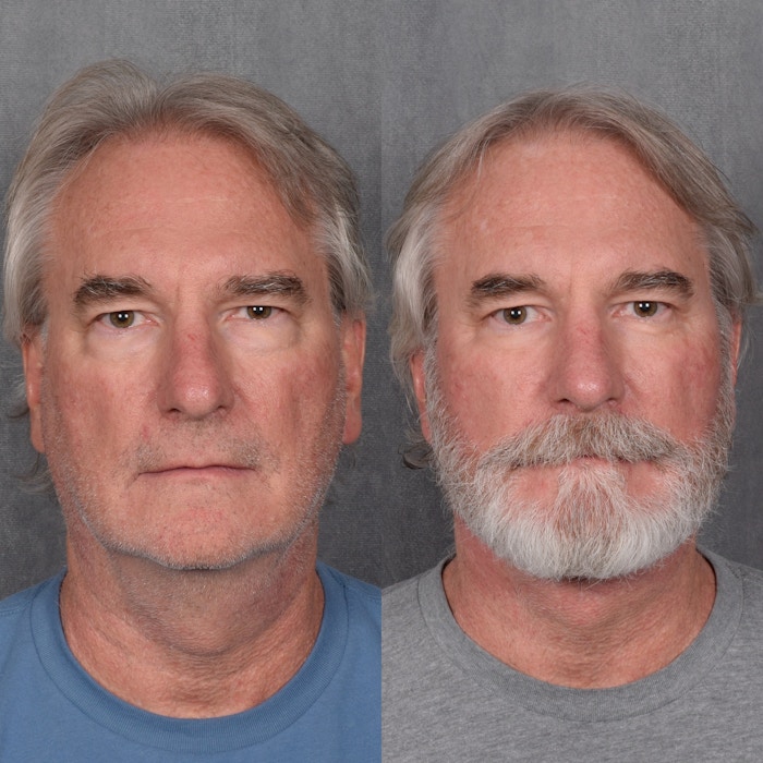 Facelift Before & After Gallery - Patient 213549 - Image 1