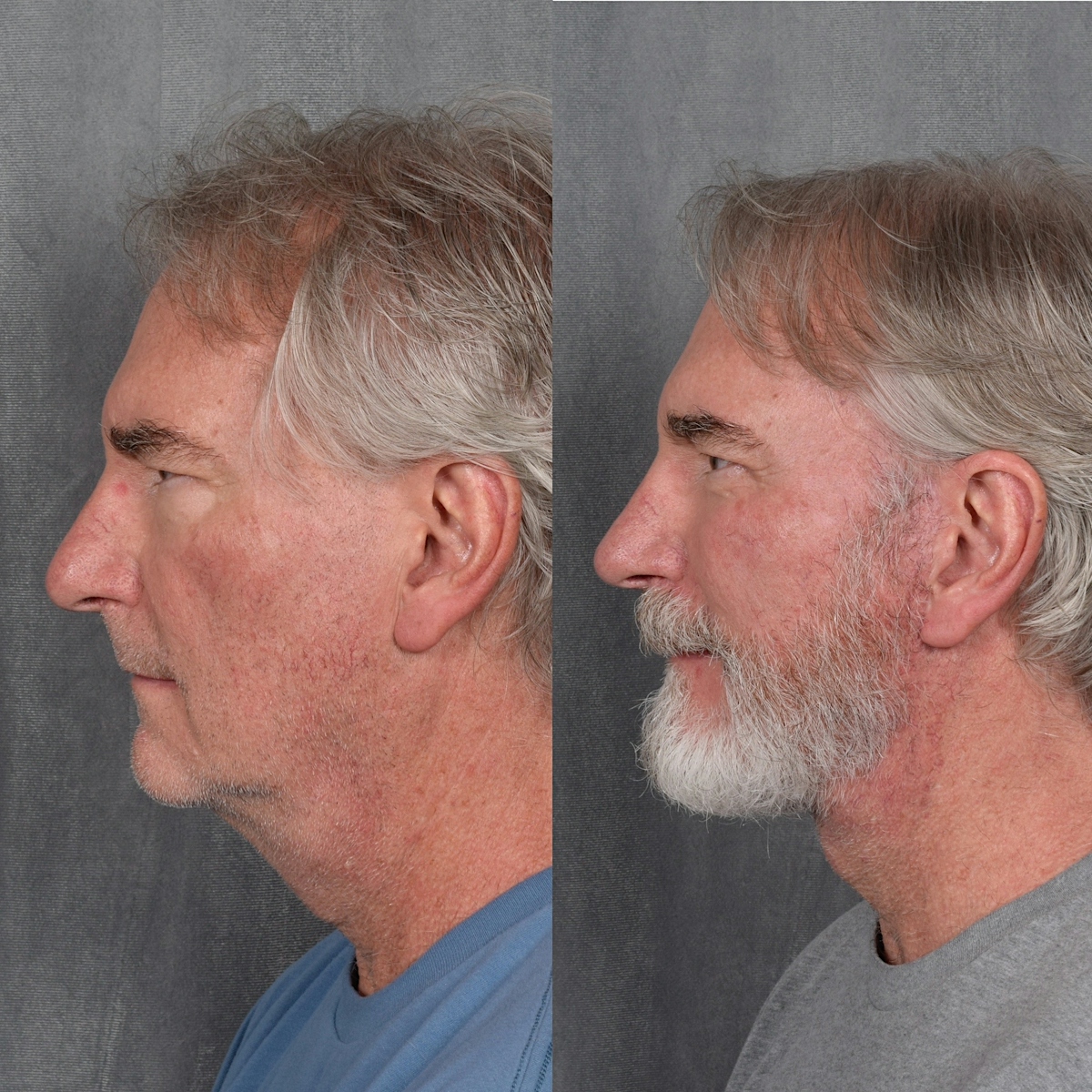 Lower Blepharoplasty Before & After Gallery - Patient 398735 - Image 1
