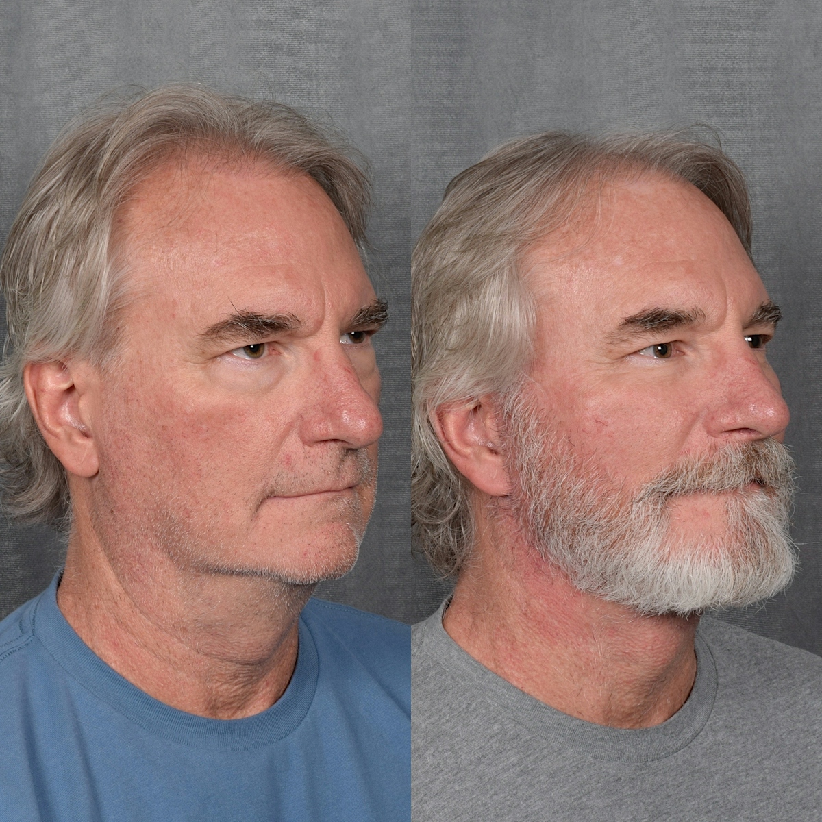 Lower Blepharoplasty Before & After Gallery - Patient 398735 - Image 5