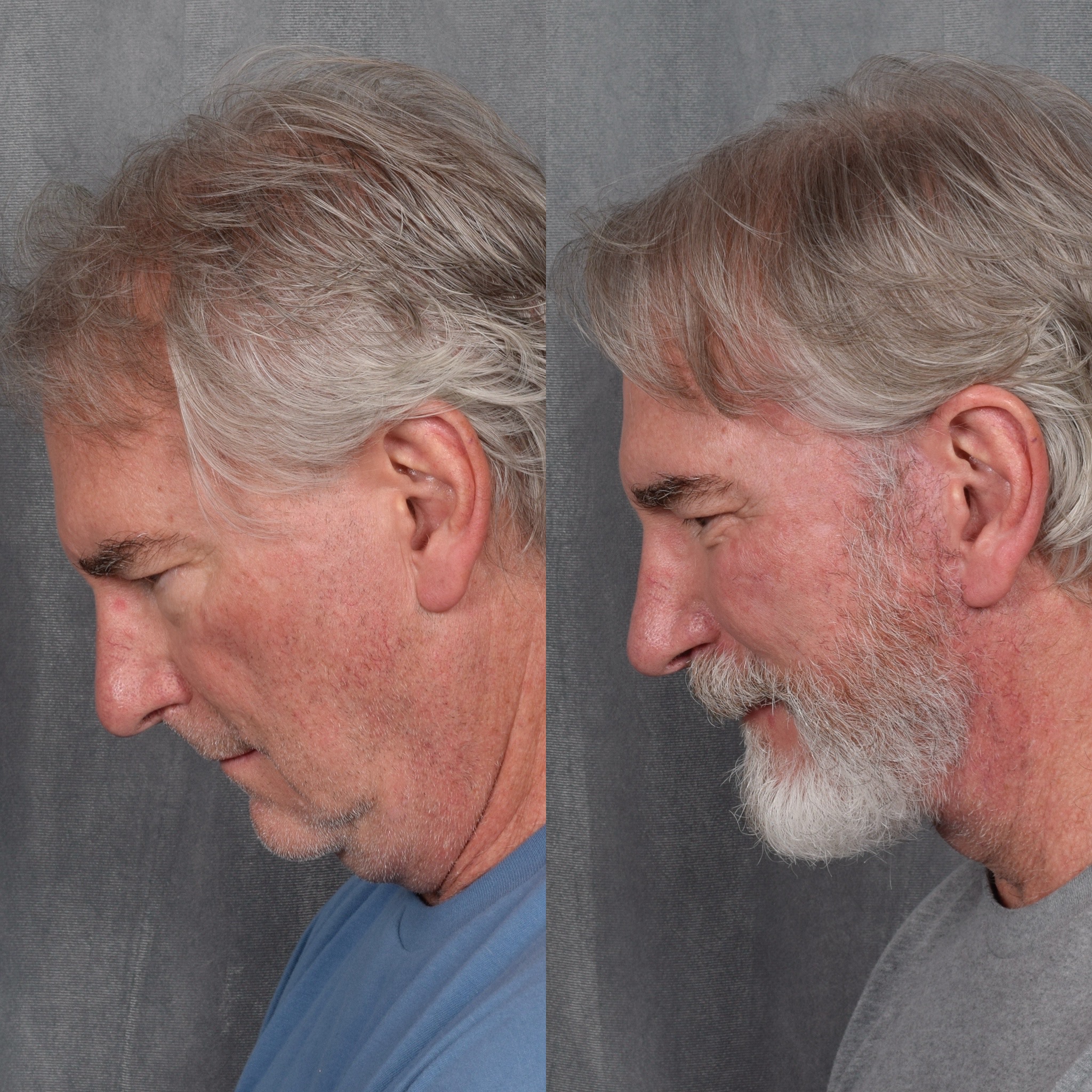Rhinoplasty Before & After Gallery - Patient 612108 - Image 2