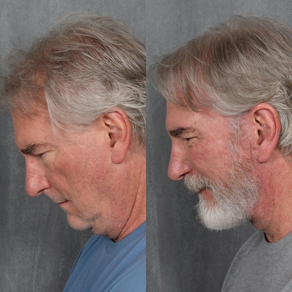 Lower Blepharoplasty Before & After Gallery - Patient 398735 - Image 2
