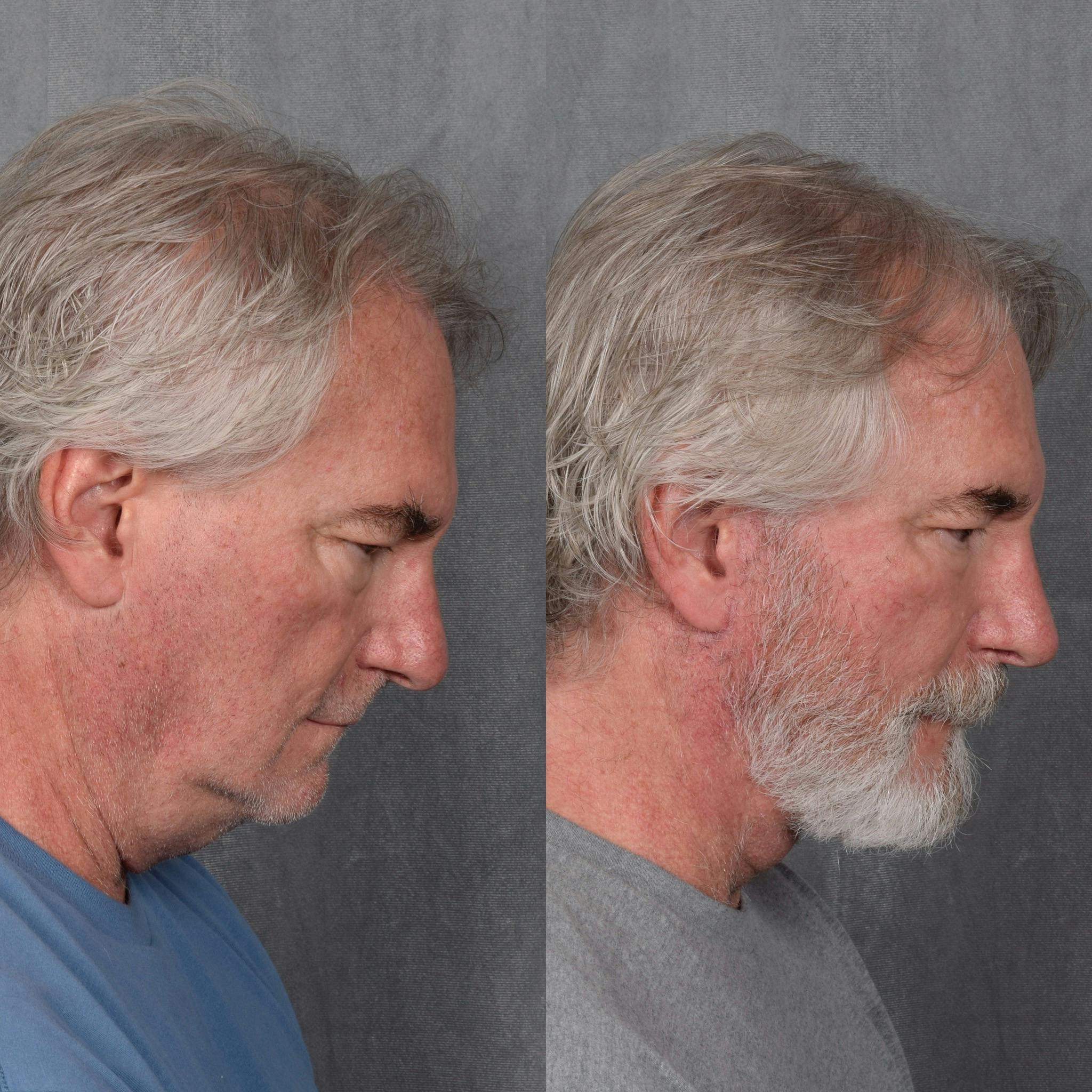 Lower Blepharoplasty Before & After Gallery - Patient 398735 - Image 6