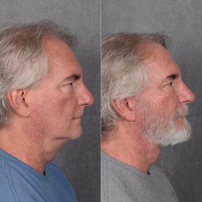 Male Rhinoplasty Before & After Gallery - Patient 402553 - Image 1