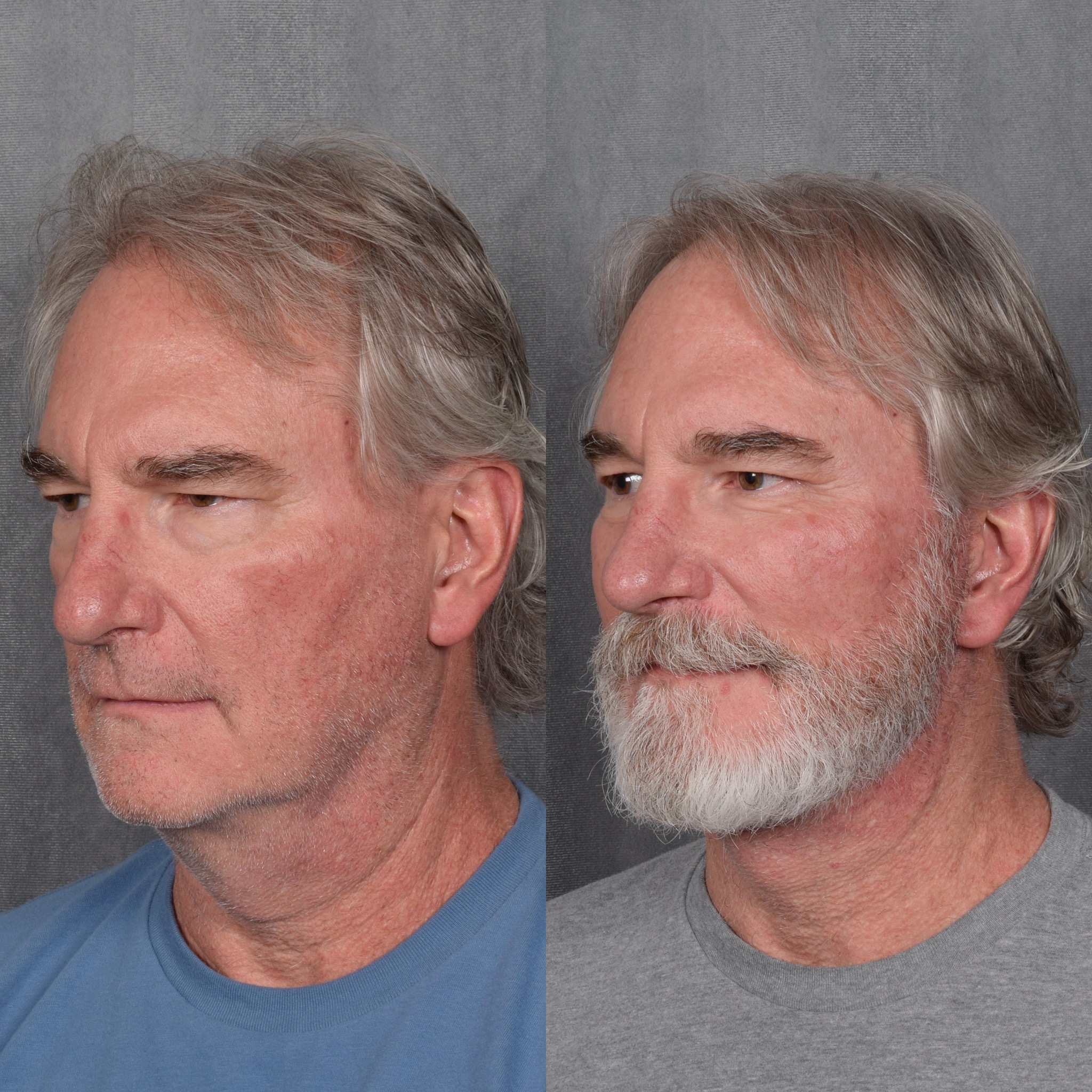 Rhinoplasty Before & After Gallery - Patient 612108 - Image 3