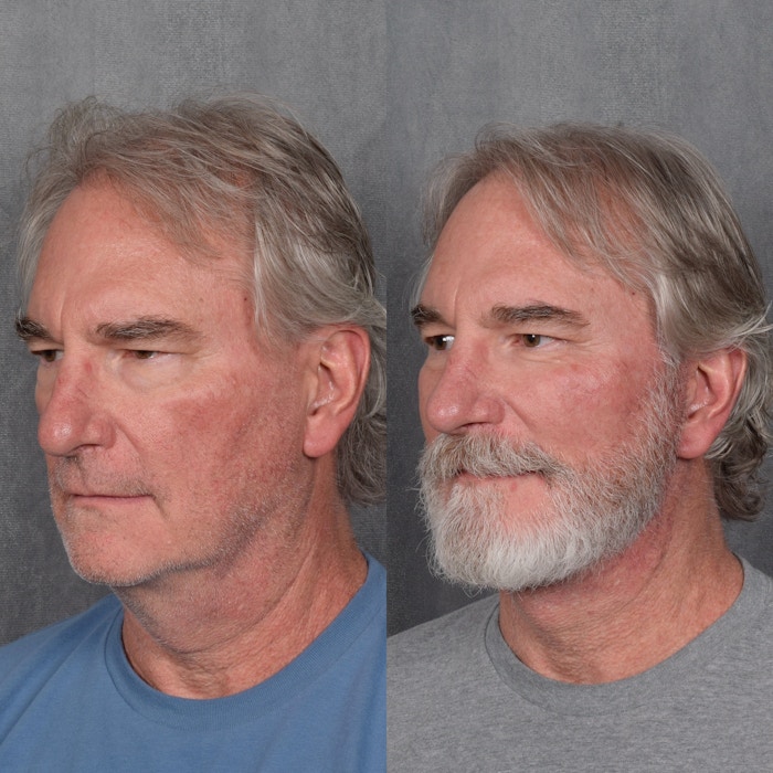 Facelift Before & After Gallery - Patient 213549 - Image 1