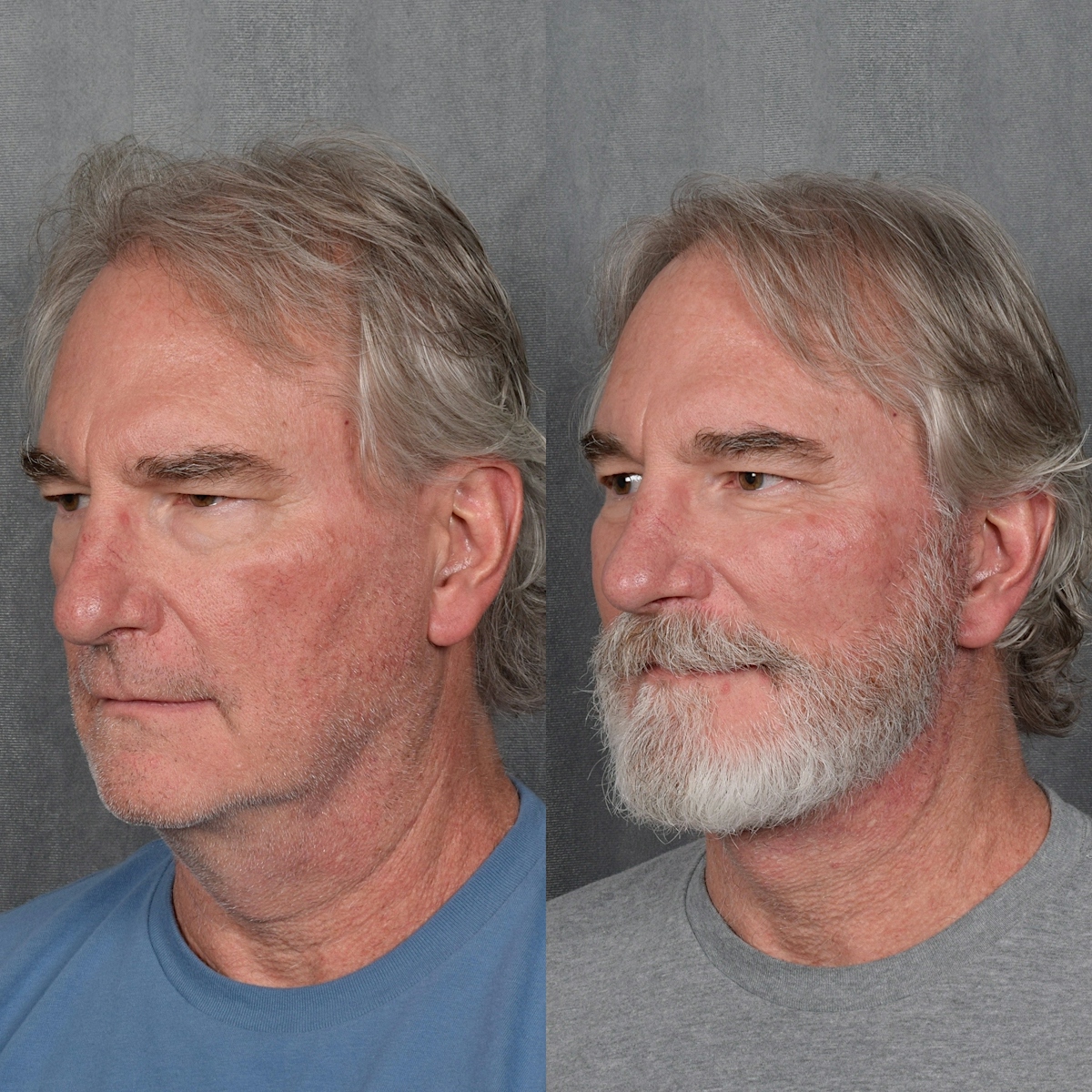 Lower Blepharoplasty Before & After Gallery - Patient 398735 - Image 3