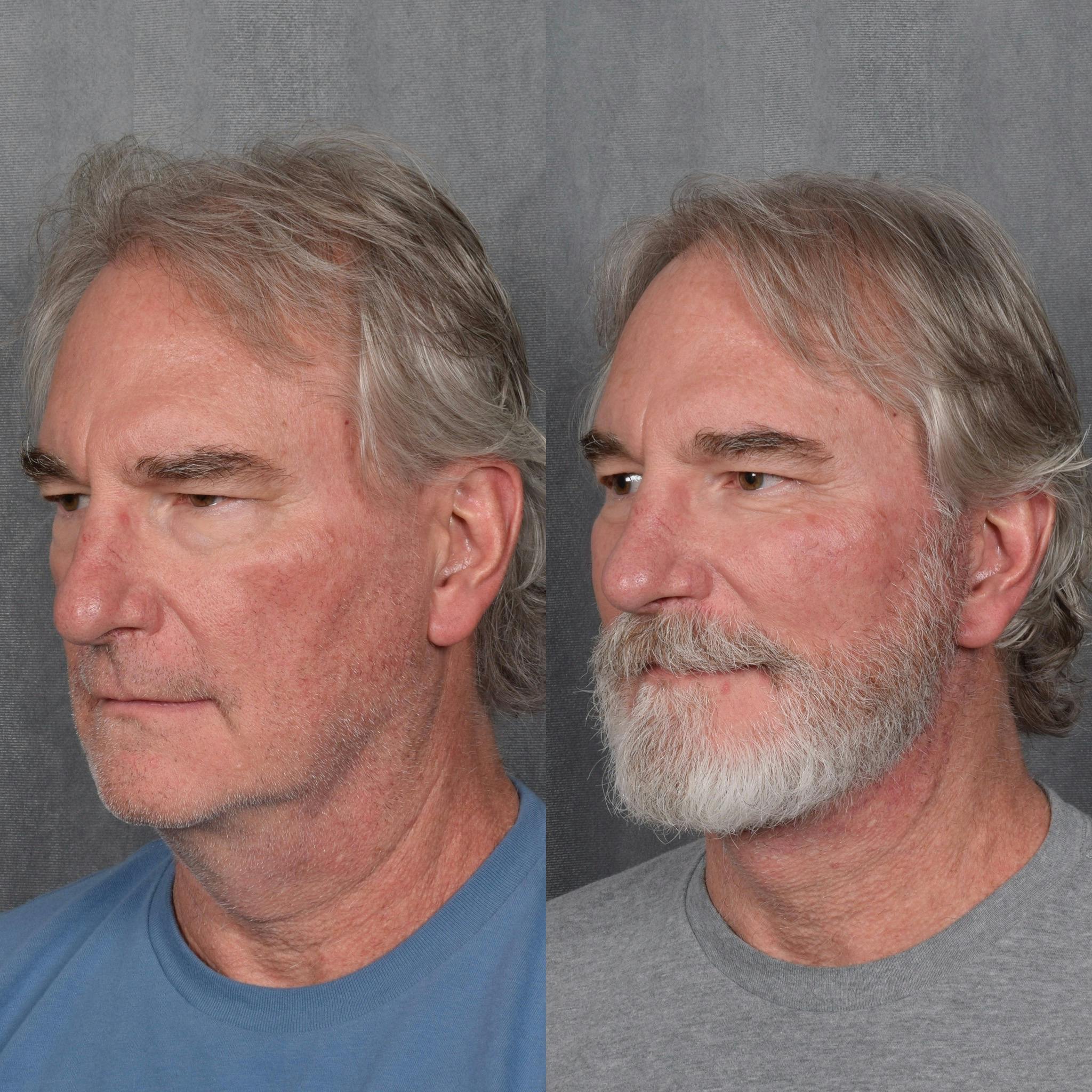 Lower Blepharoplasty Before & After Gallery - Patient 398735 - Image 3