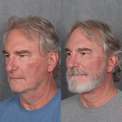 Facelift Before & After Gallery - Patient 213549 - Image 1