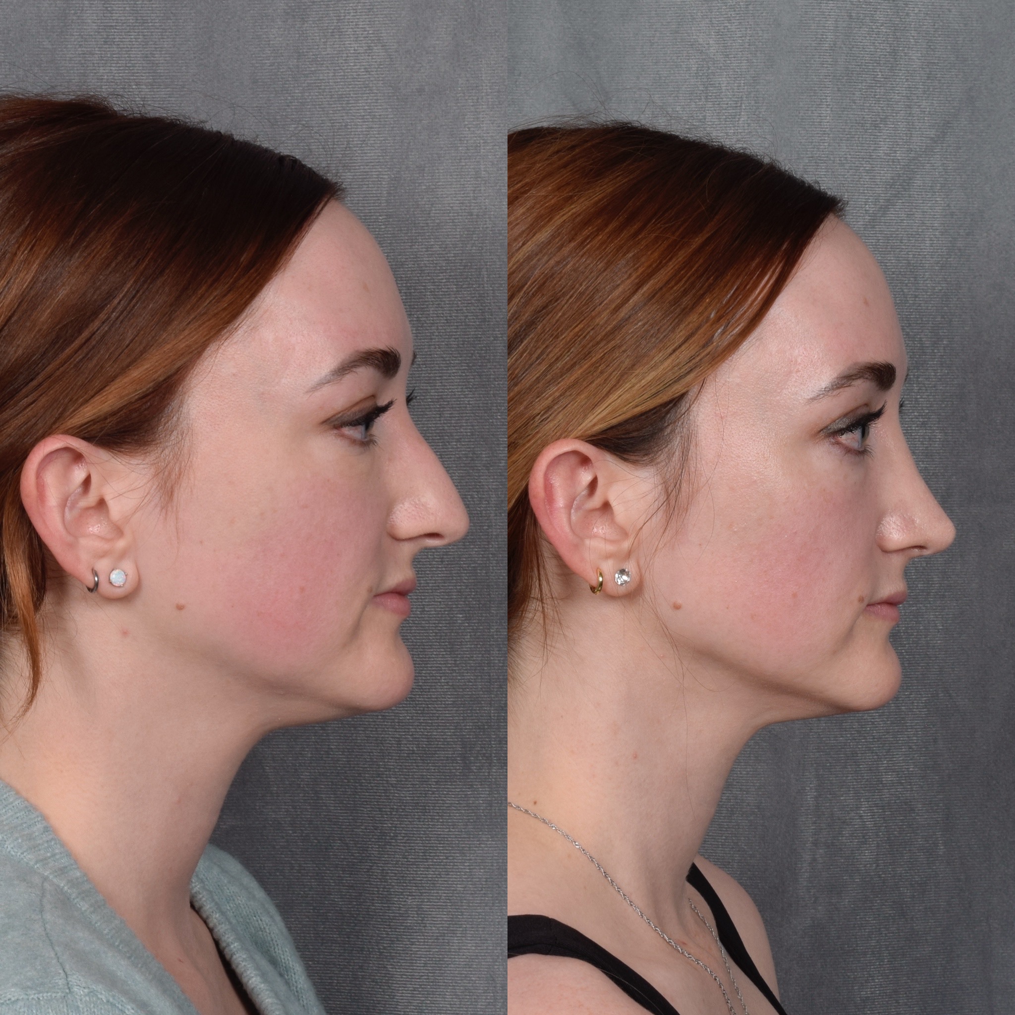 Rhinoplasty Before & After Gallery - Patient 385730 - Image 6