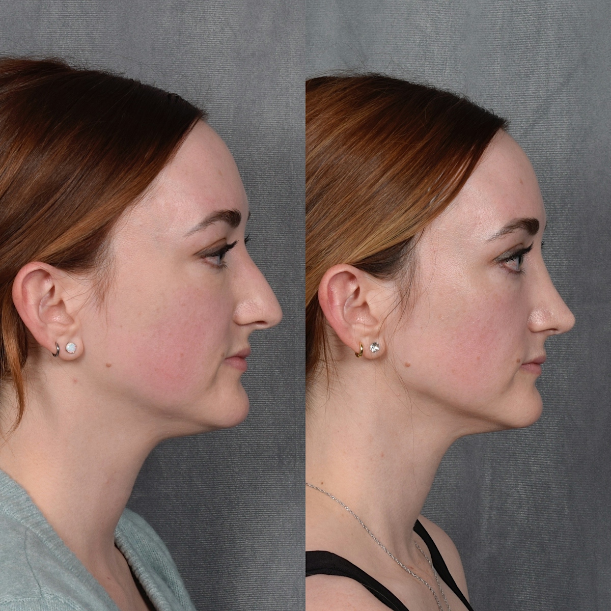 Rhinoplasty Before & After Gallery - Patient 385730 - Image 6