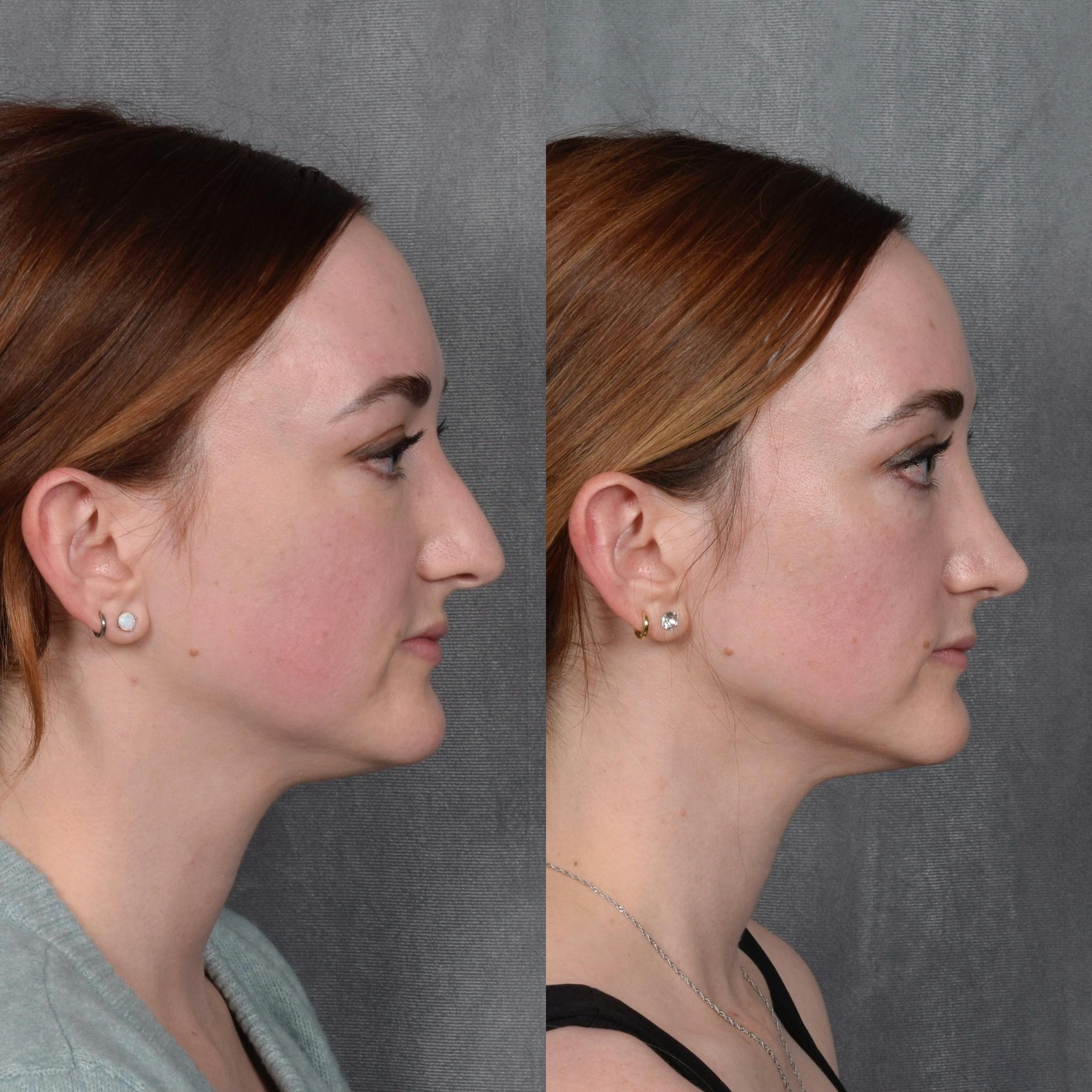 Rhinoplasty Before & After Gallery - Patient 385730 - Image 6