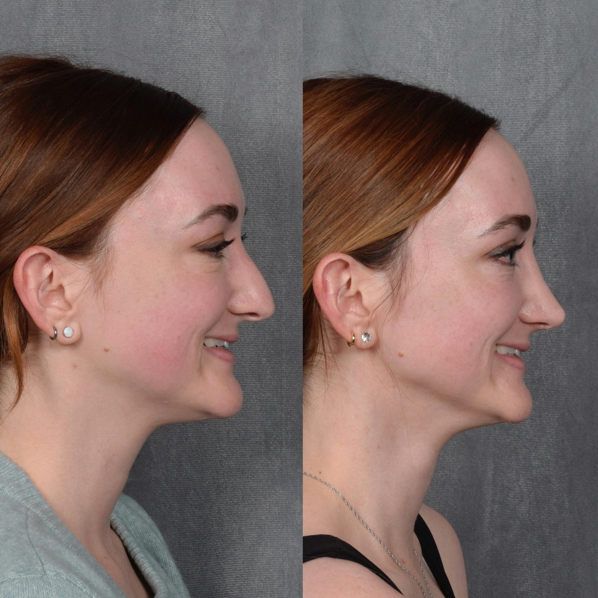 Rhinoplasty Before & After Gallery - Patient 385730 - Image 7