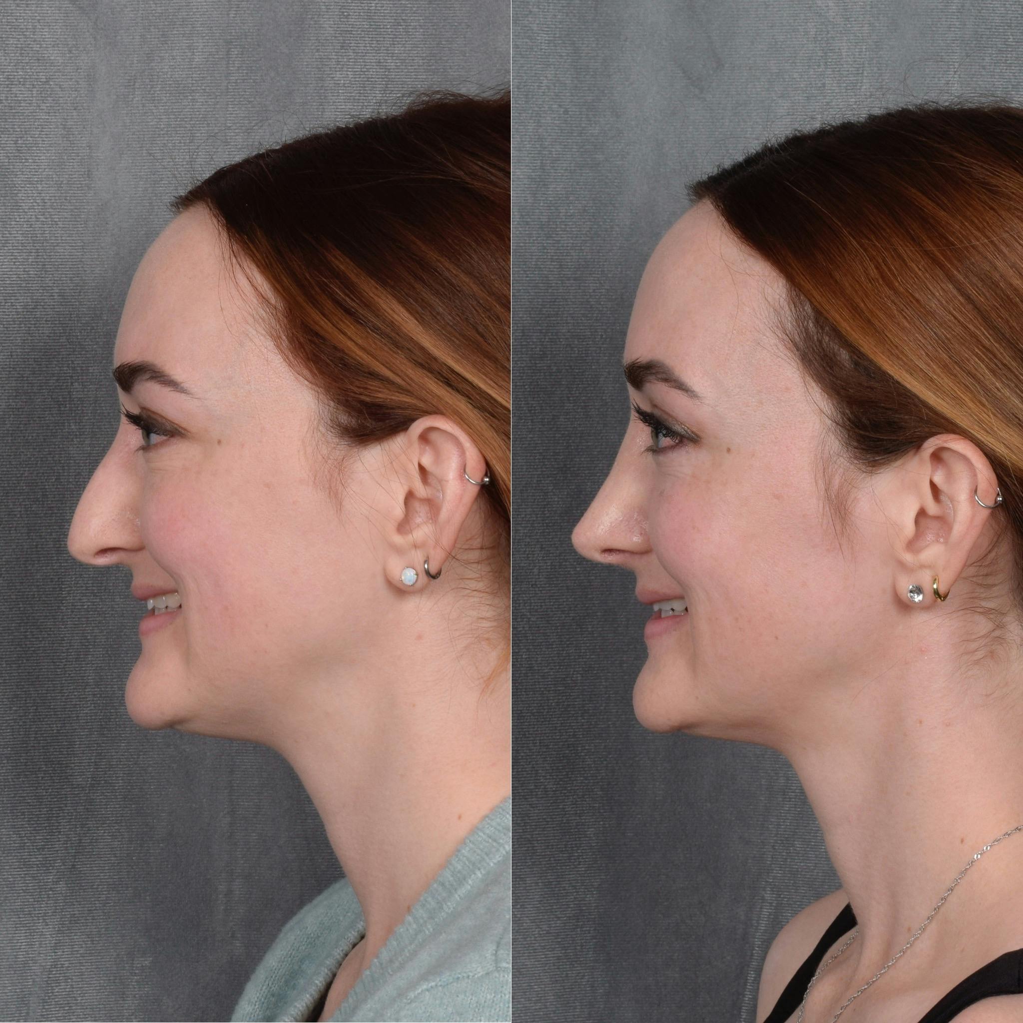 Rhinoplasty Before & After Gallery - Patient 385730 - Image 1