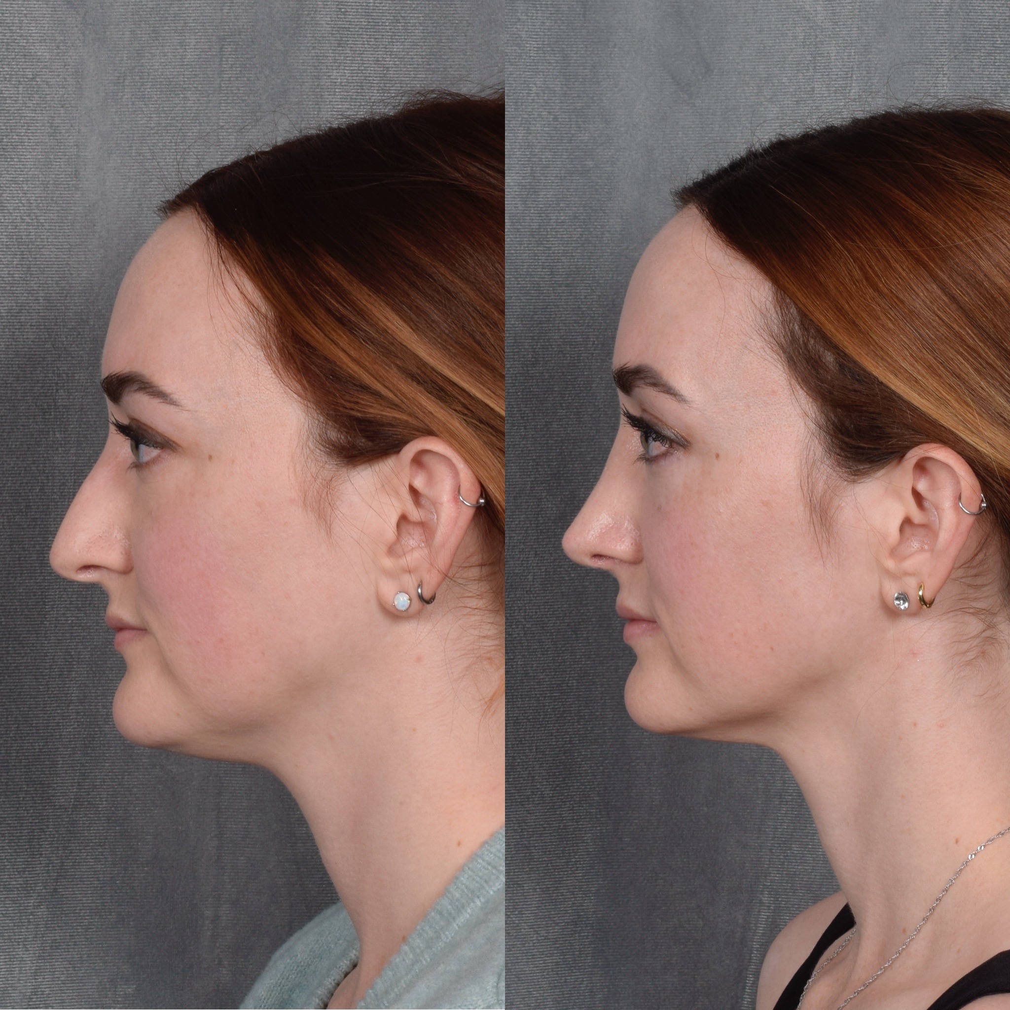 Rhinoplasty Before & After Gallery - Patient 385730 - Image 2