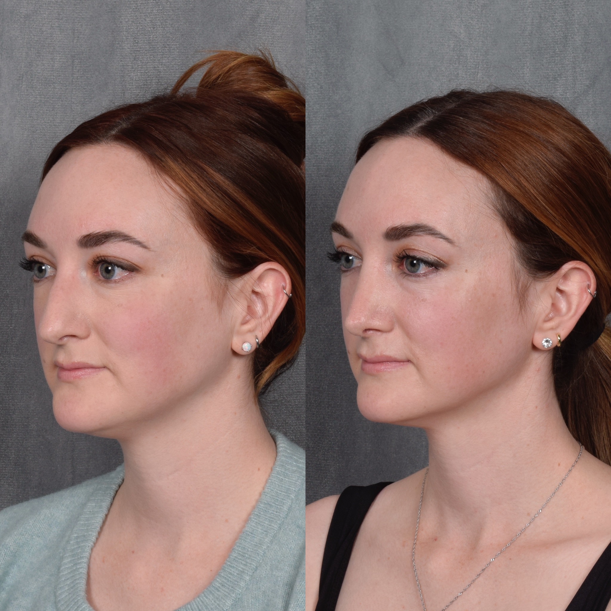 Rhinoplasty Before & After Gallery - Patient 385730 - Image 3