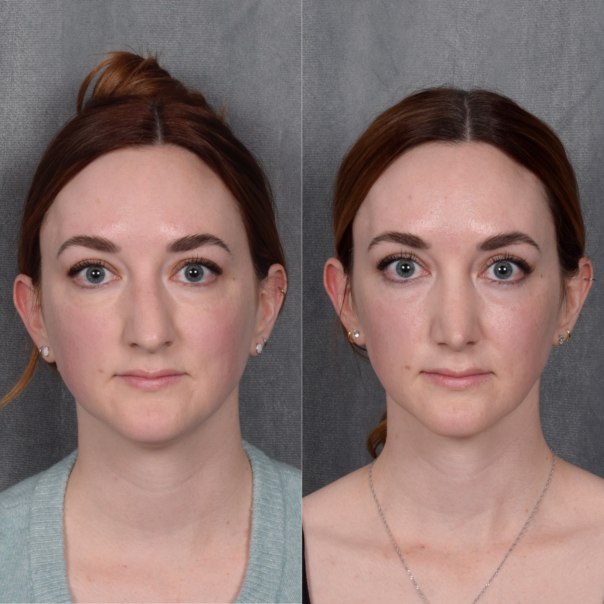 Rhinoplasty Before & After Gallery - Patient 385730 - Image 4