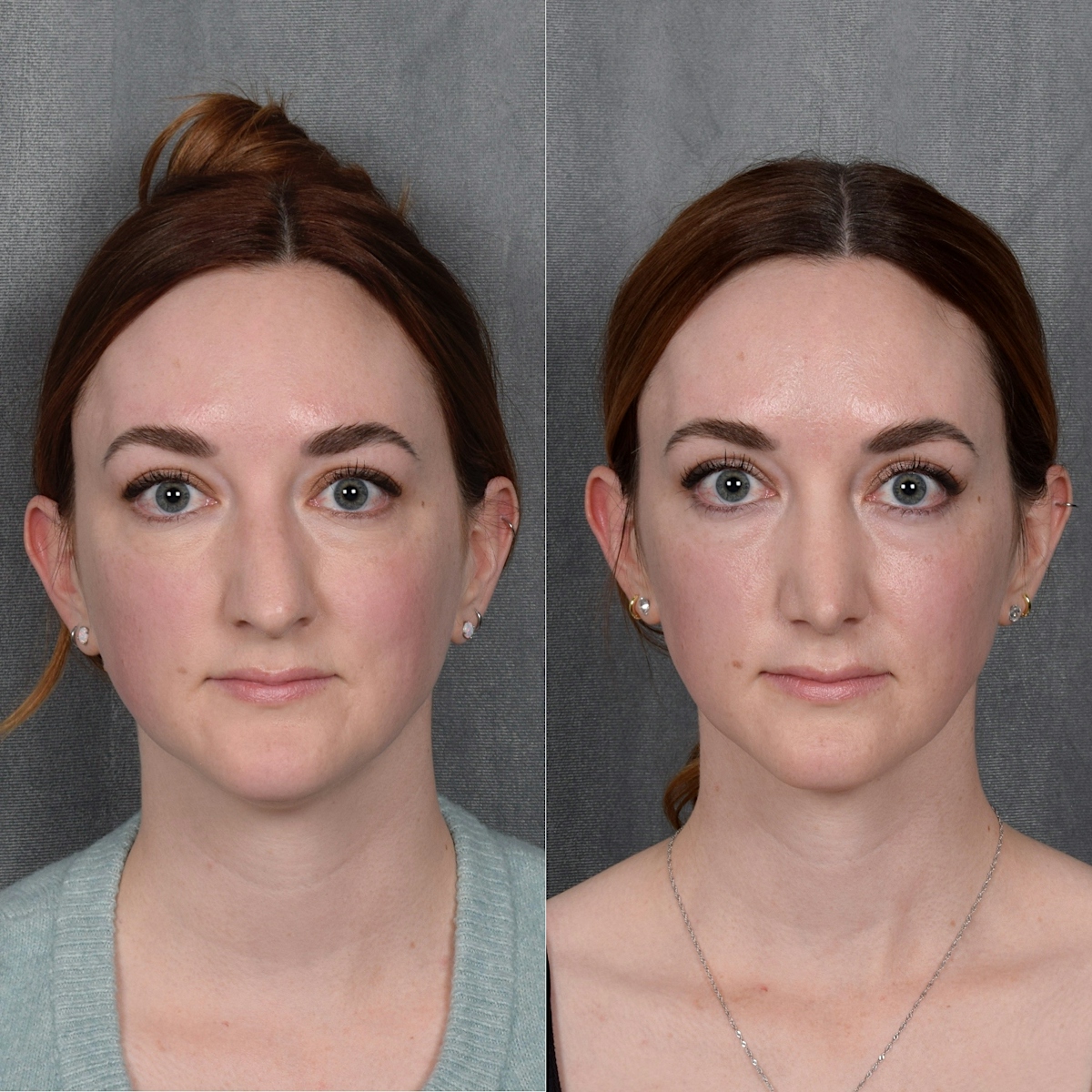 Rhinoplasty Before & After Gallery - Patient 385730 - Image 4
