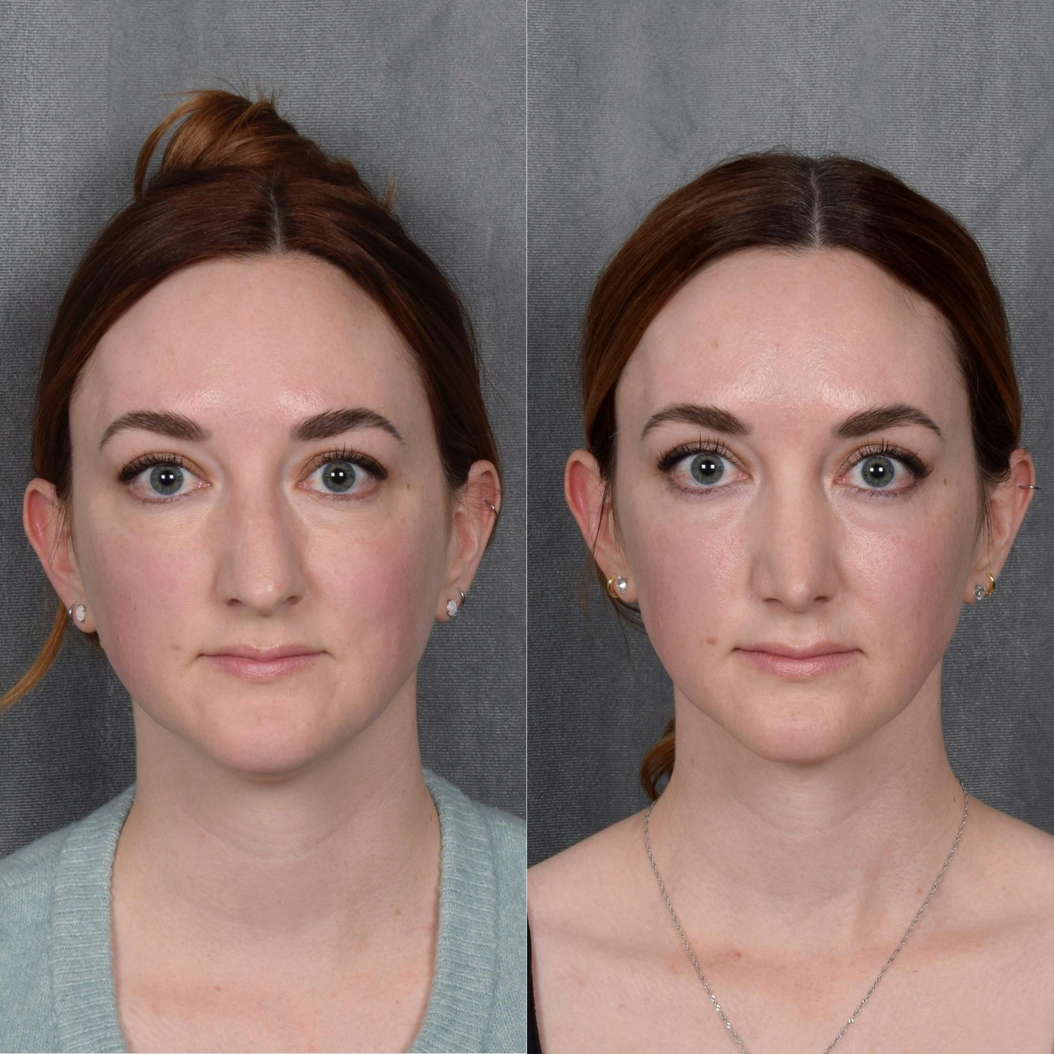 Rhinoplasty Before & After Gallery - Patient 385730 - Image 4
