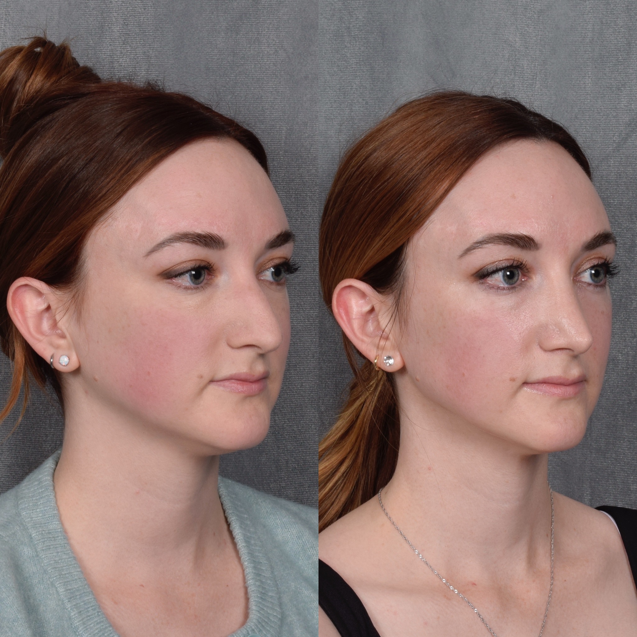 Rhinoplasty Before & After Gallery - Patient 385730 - Image 5