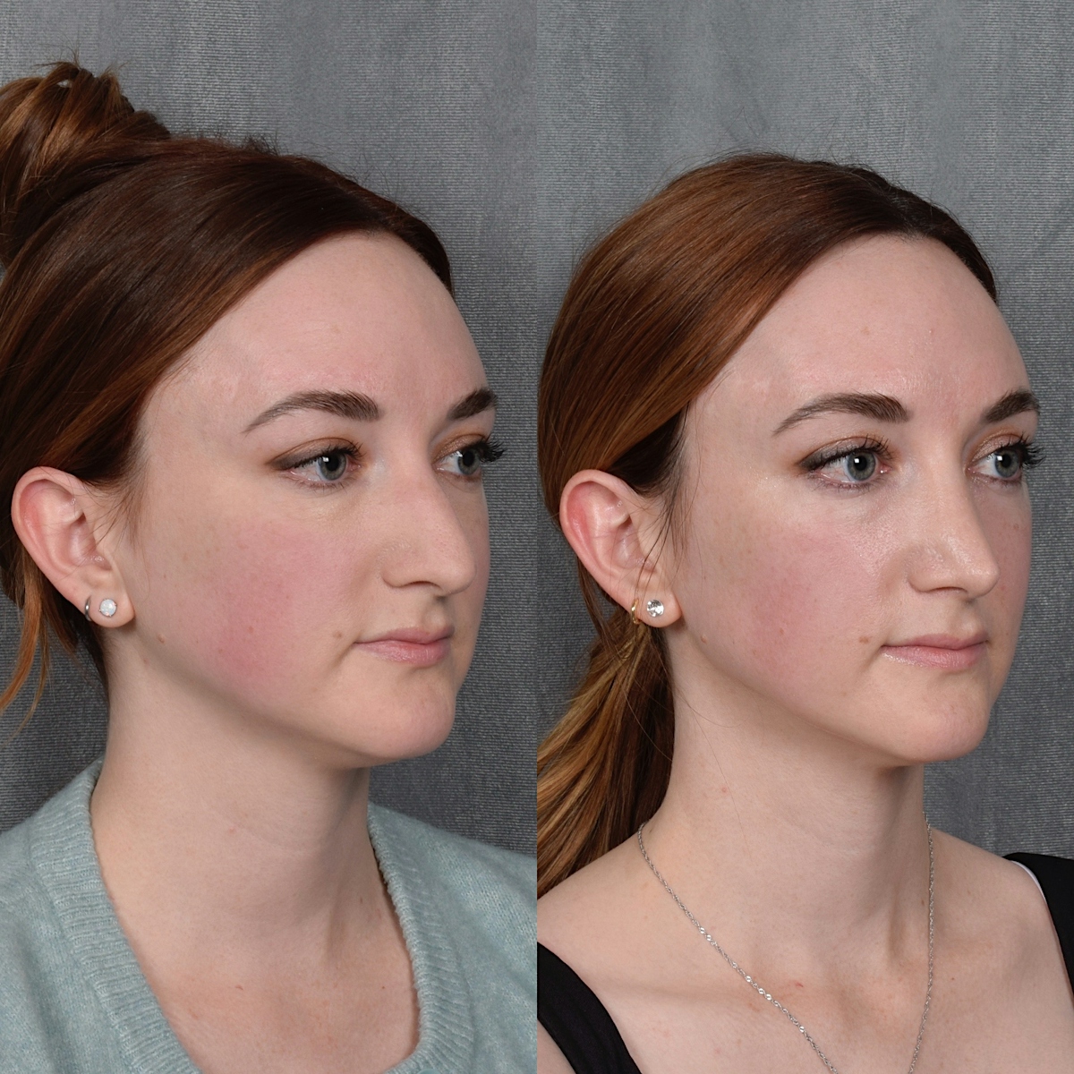 Rhinoplasty Before & After Gallery - Patient 385730 - Image 5