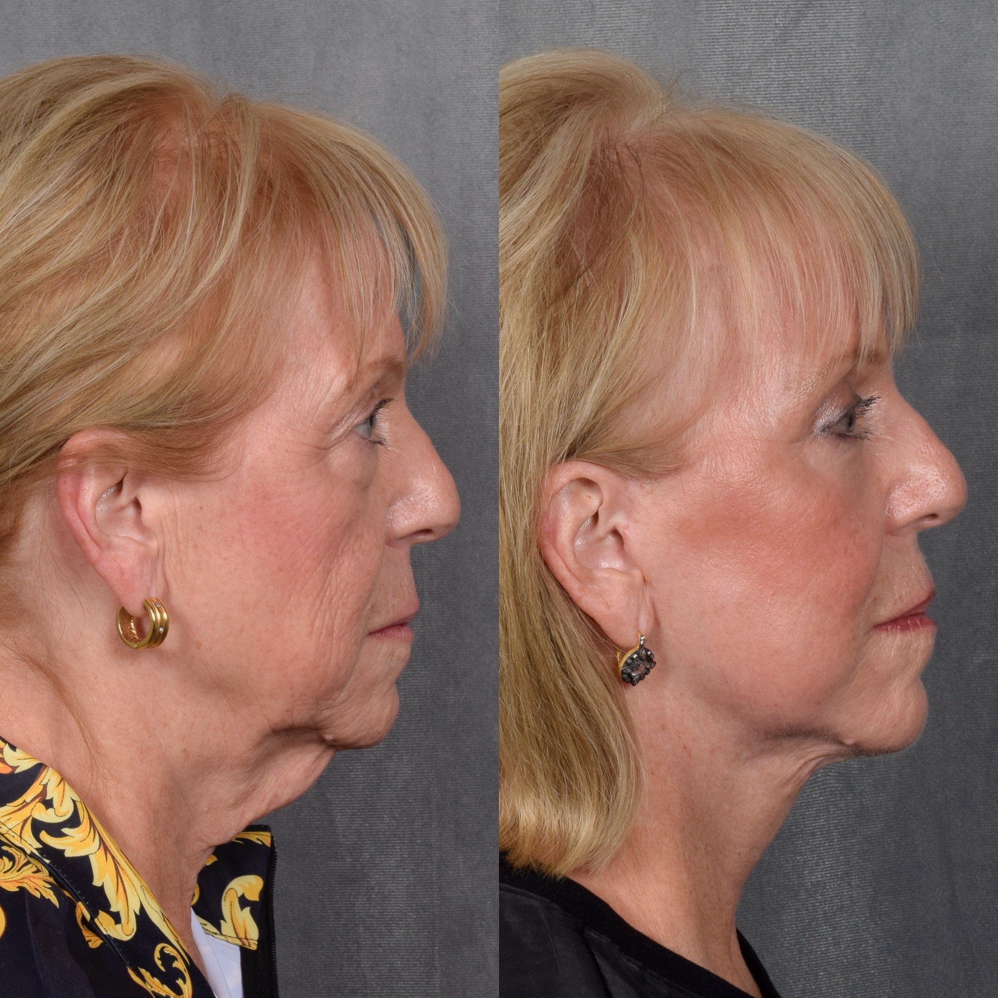 Facelift Before & After Gallery - Patient 105442 - Image 4