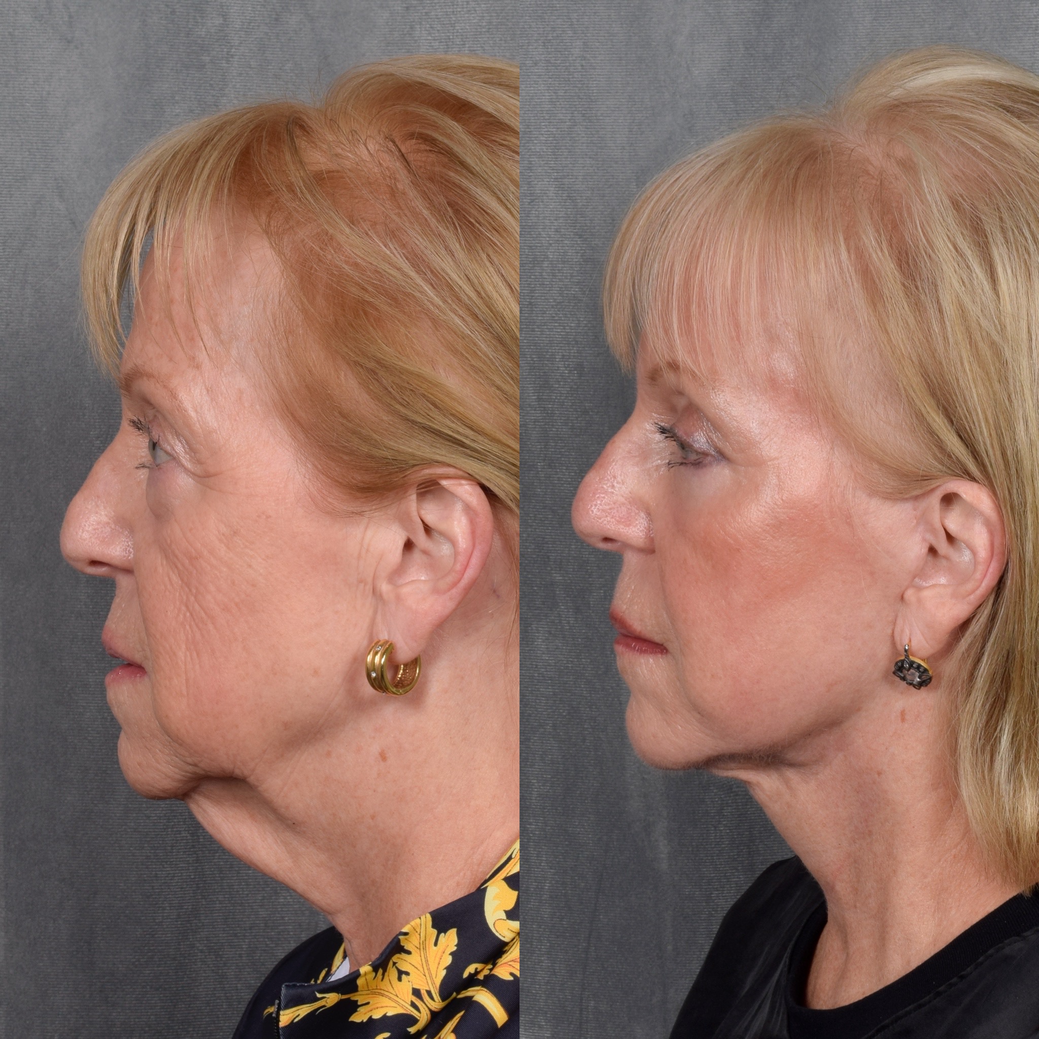 Facelift Before & After Gallery - Patient 105442 - Image 3