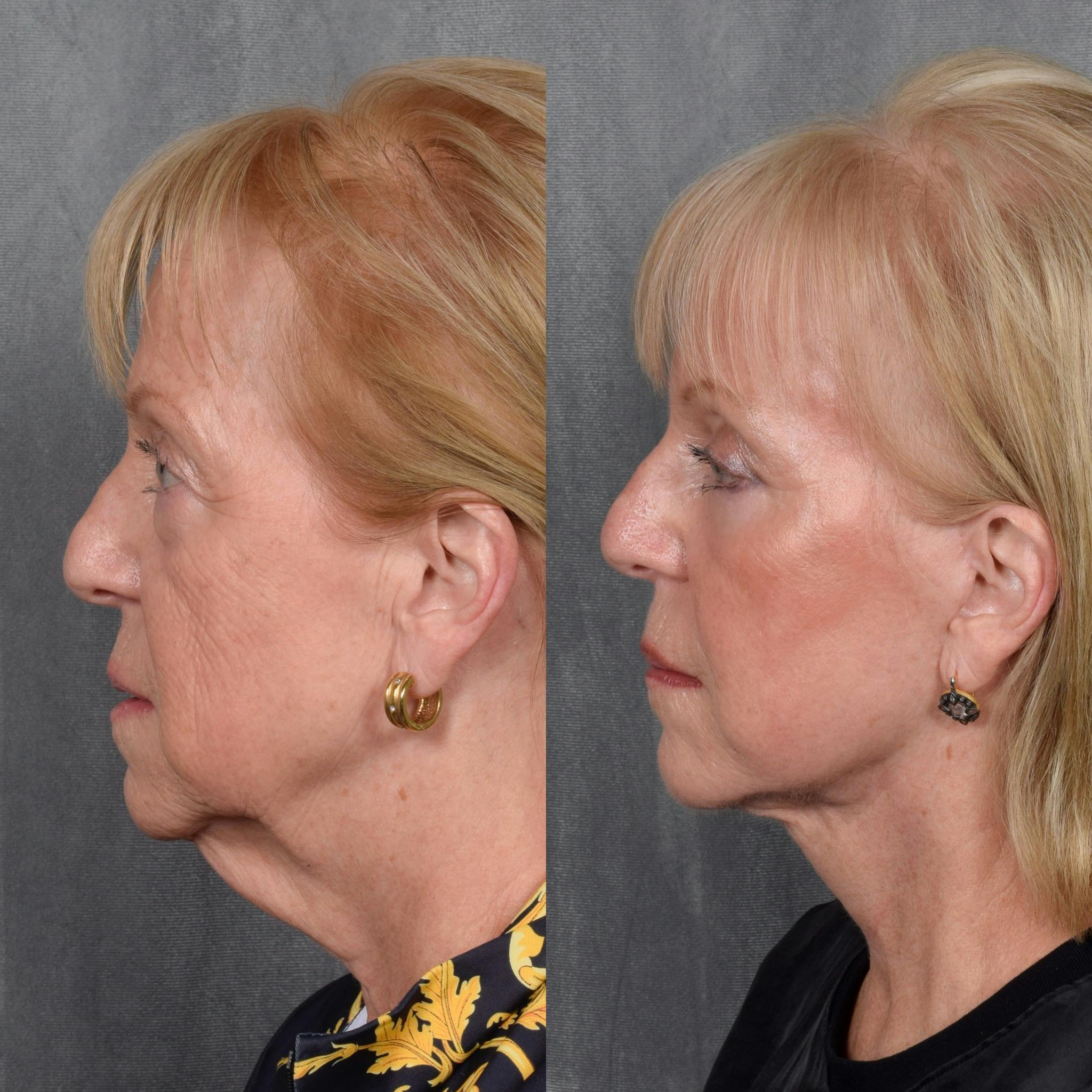 CO2 Laser Before & After Gallery - Patient 262818 - Image 3