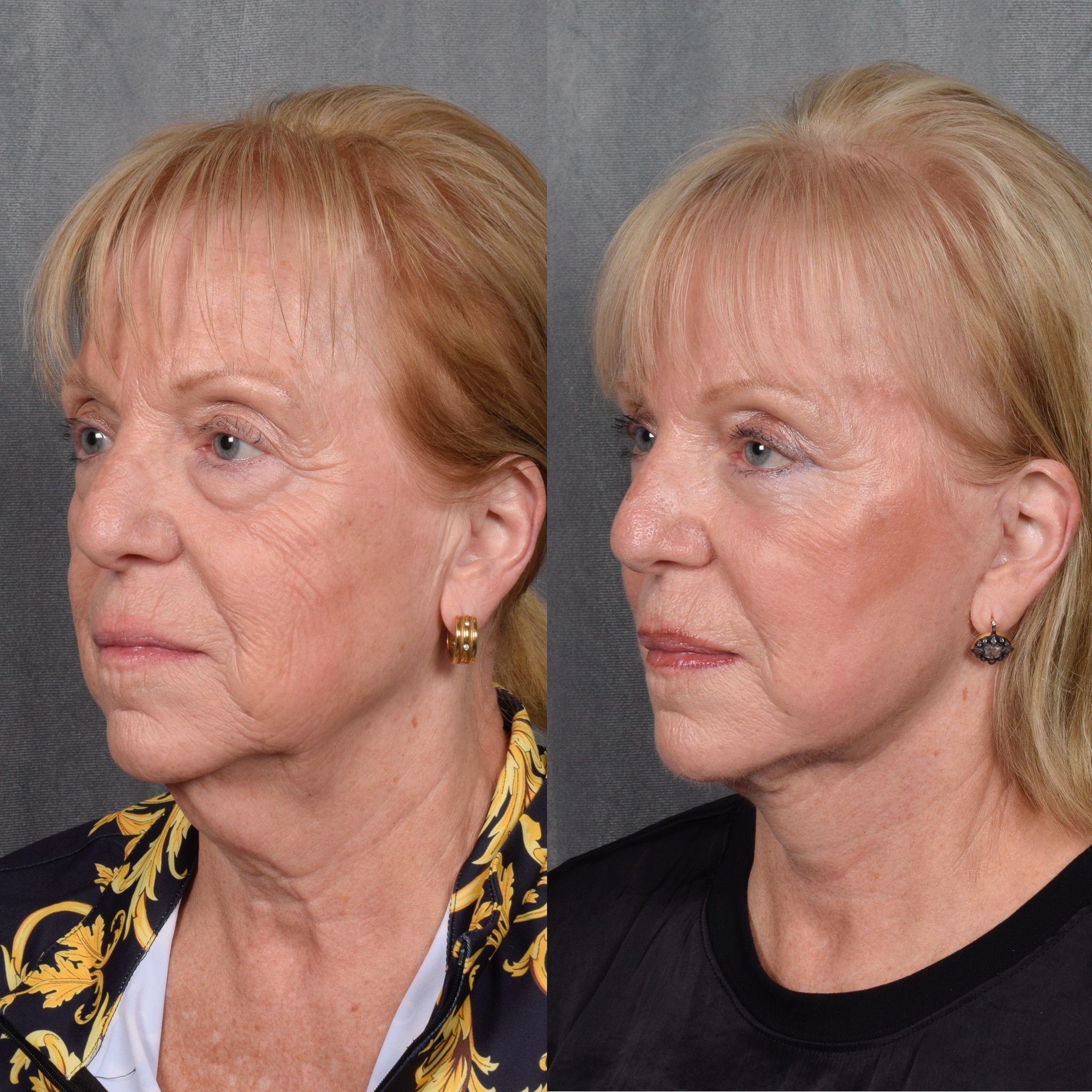 Facelift Before & After Gallery - Patient 105442 - Image 1