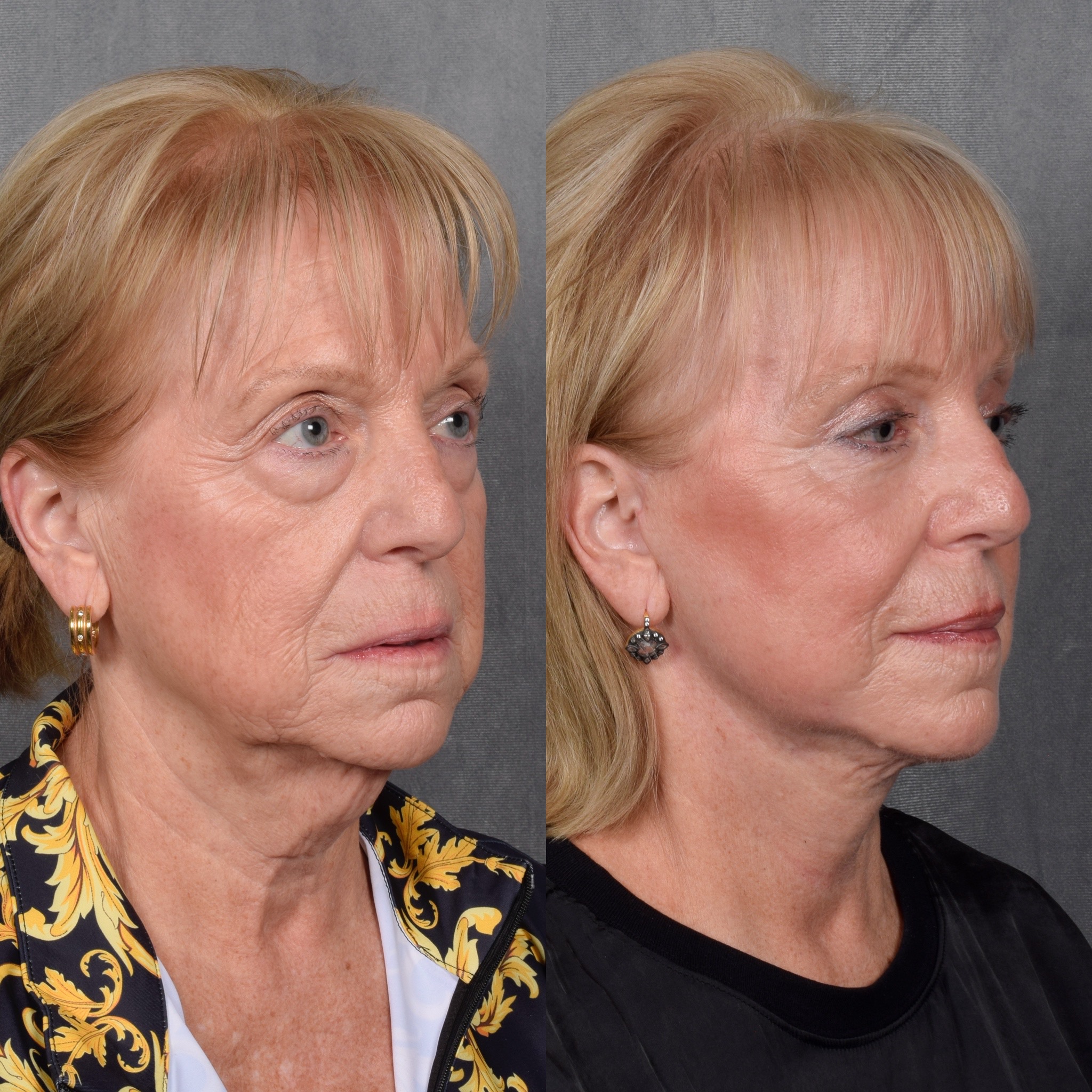 Facelift Before & After Gallery - Patient 105442 - Image 2