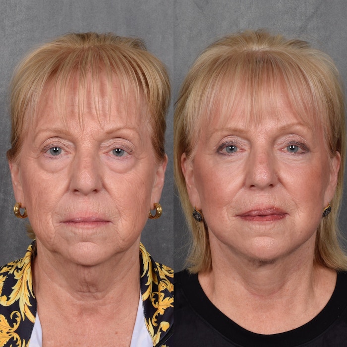 Facelift Before & After Gallery - Patient 105442 - Image 1