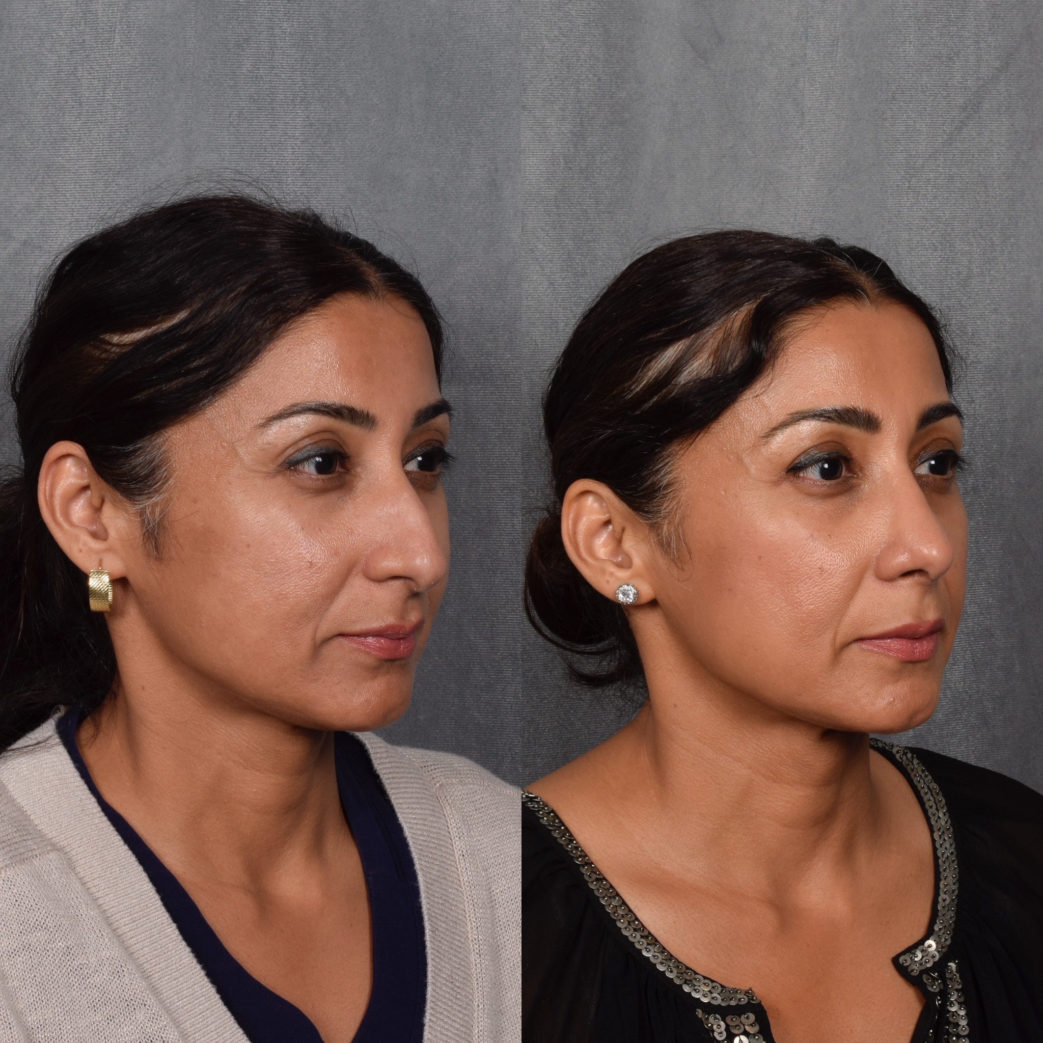 Rhinoplasty Before & After Gallery - Patient 568798 - Image 5
