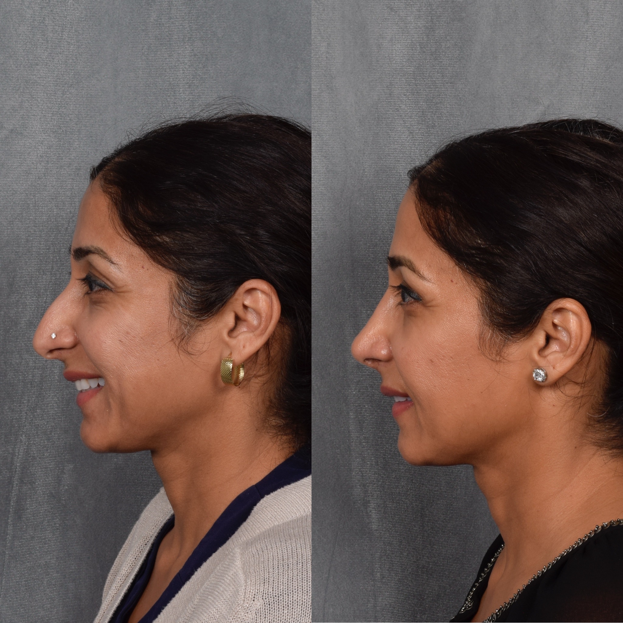 Rhinoplasty Before & After Gallery - Patient 568798 - Image 1