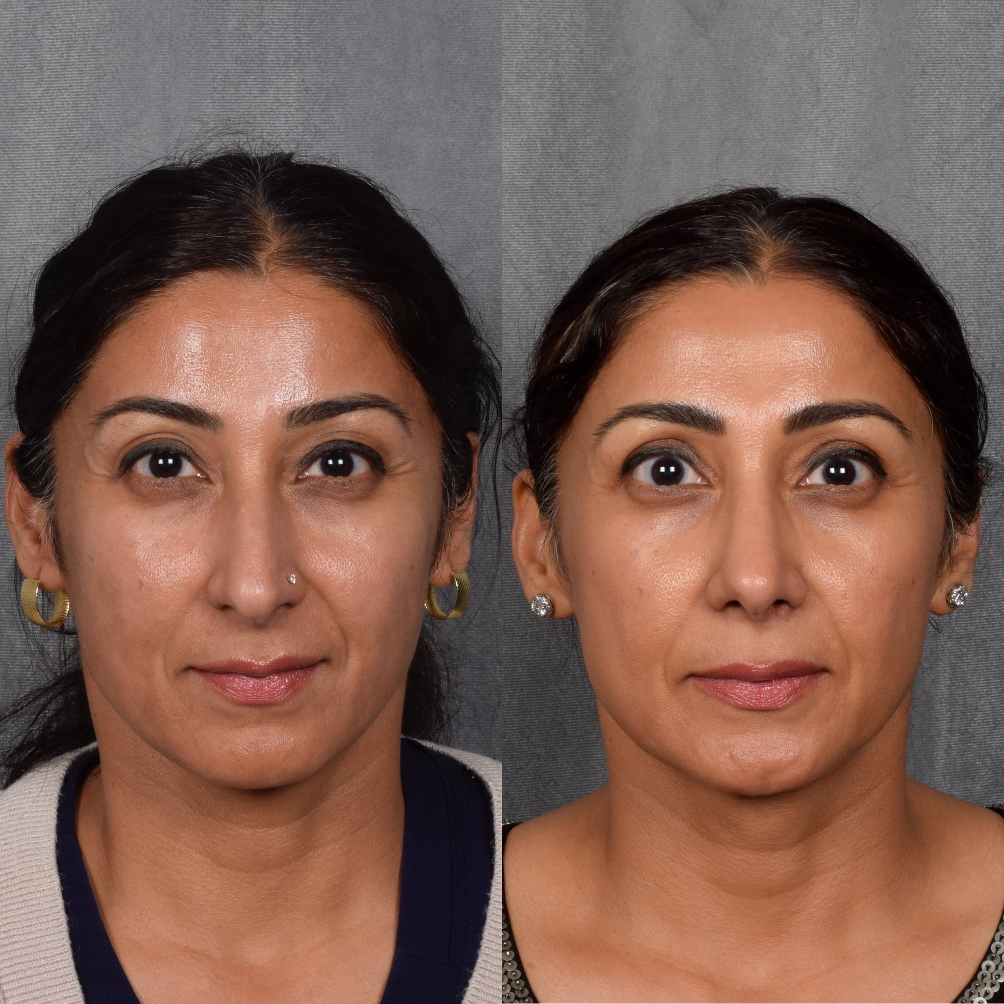 Rhinoplasty Before & After Gallery - Patient 568798 - Image 4