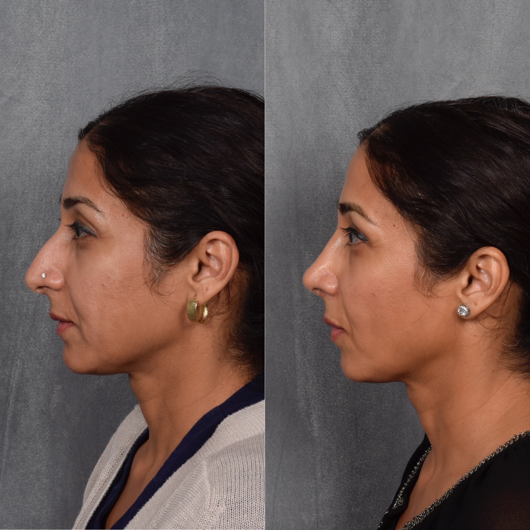 Rhinoplasty Before & After Gallery - Patient 568798 - Image 2