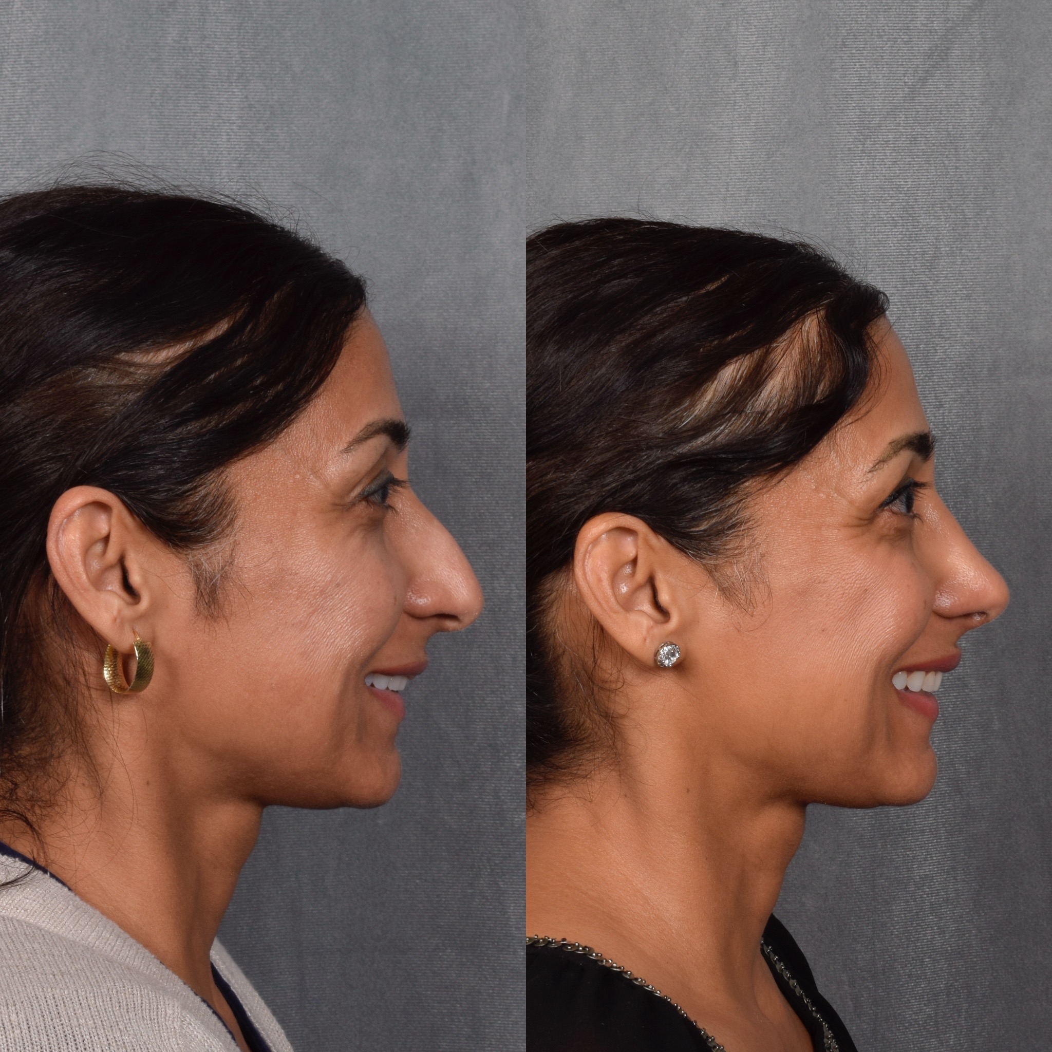 Rhinoplasty Before & After Gallery - Patient 568798 - Image 7