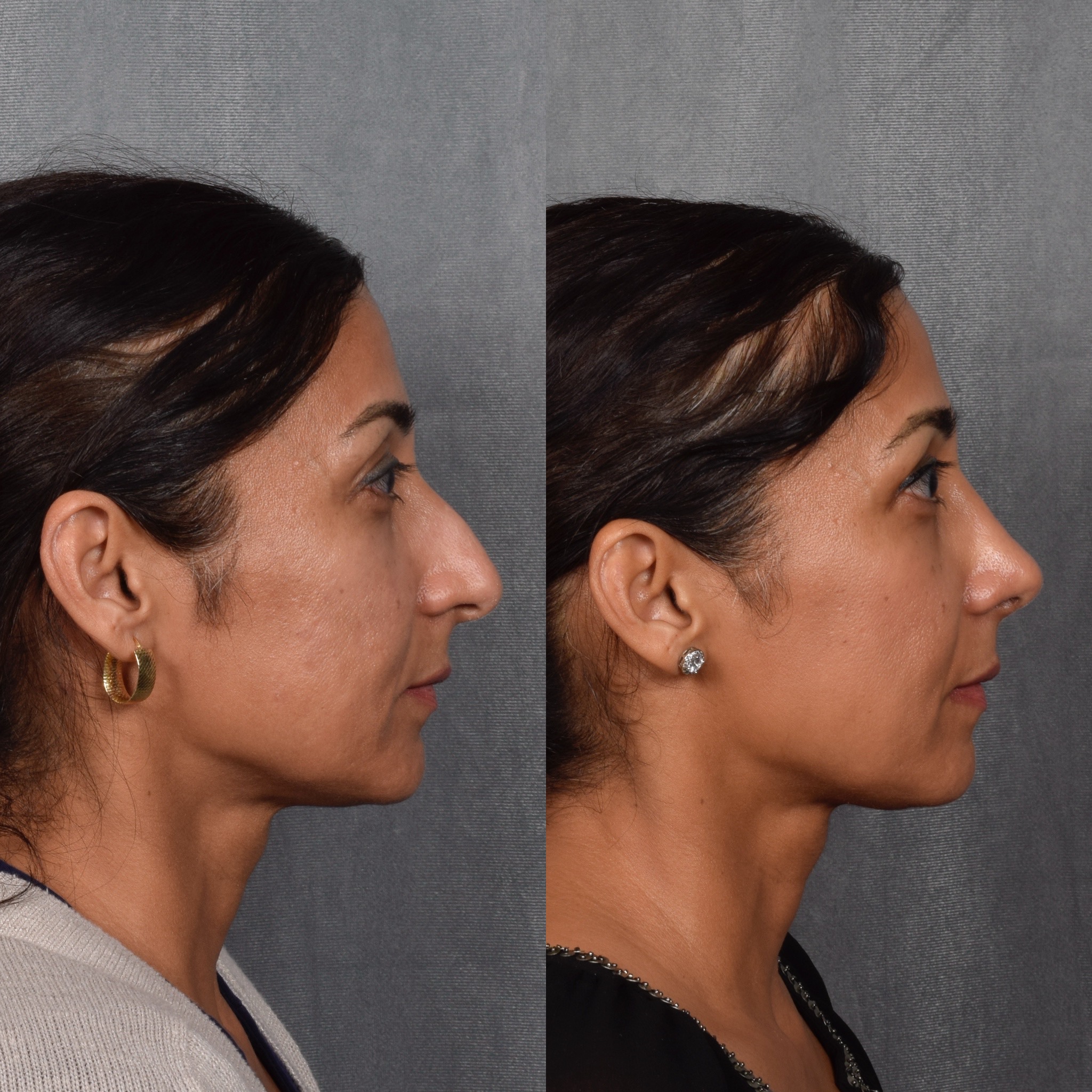 Rhinoplasty Before & After Gallery - Patient 568798 - Image 6