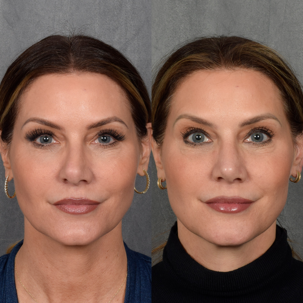 Rhinoplasty Before & After Gallery - Patient 188627 - Image 3