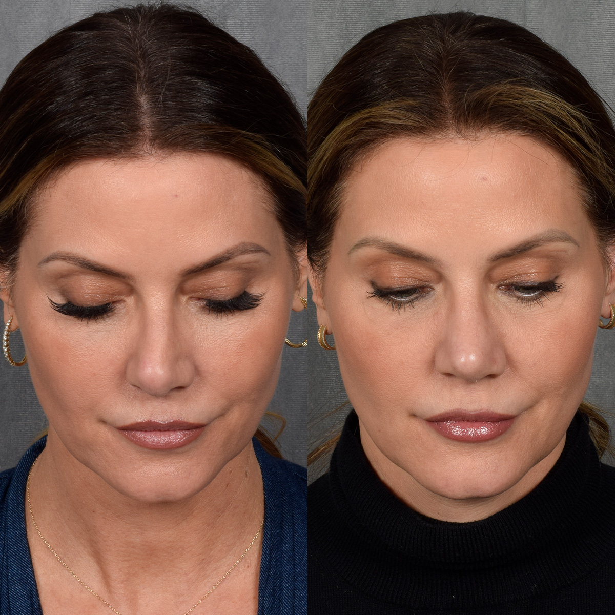 Rhinoplasty Before & After Gallery - Patient 188627 - Image 4