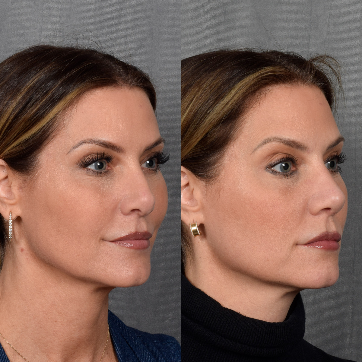 Rhinoplasty Before & After Gallery - Patient 188627 - Image 5