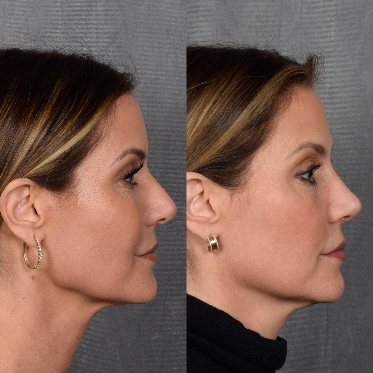 Rhinoplasty Before & After Gallery - Patient 188627 - Image 6