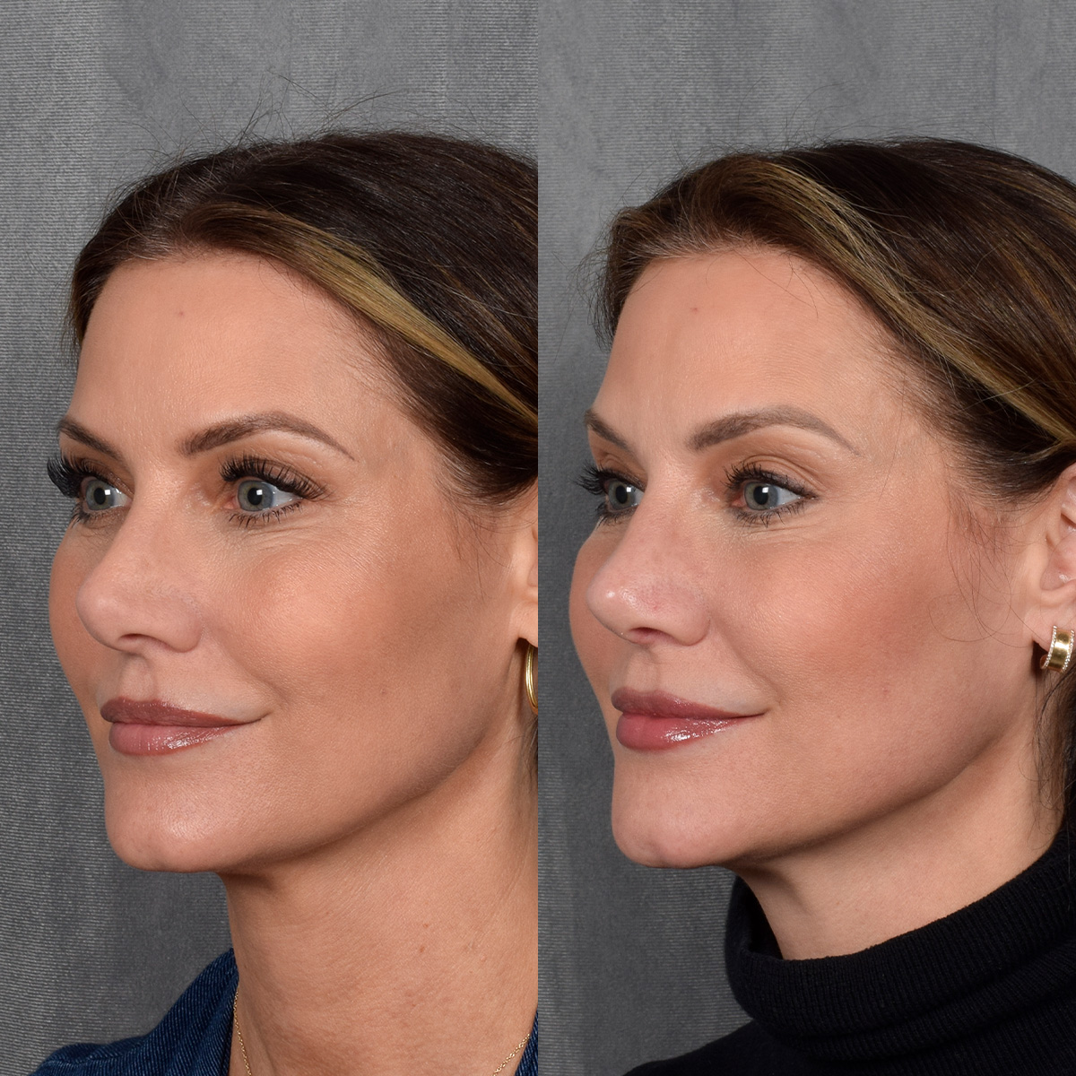 Rhinoplasty Before & After Gallery - Patient 188627 - Image 2