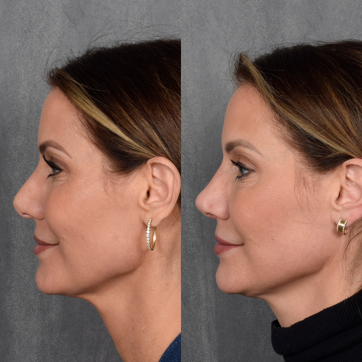 Rhinoplasty Before & After Gallery - Patient 188627 - Image 1