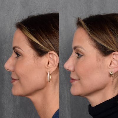 Rhinoplasty Before & After Gallery - Patient 188627 - Image 1